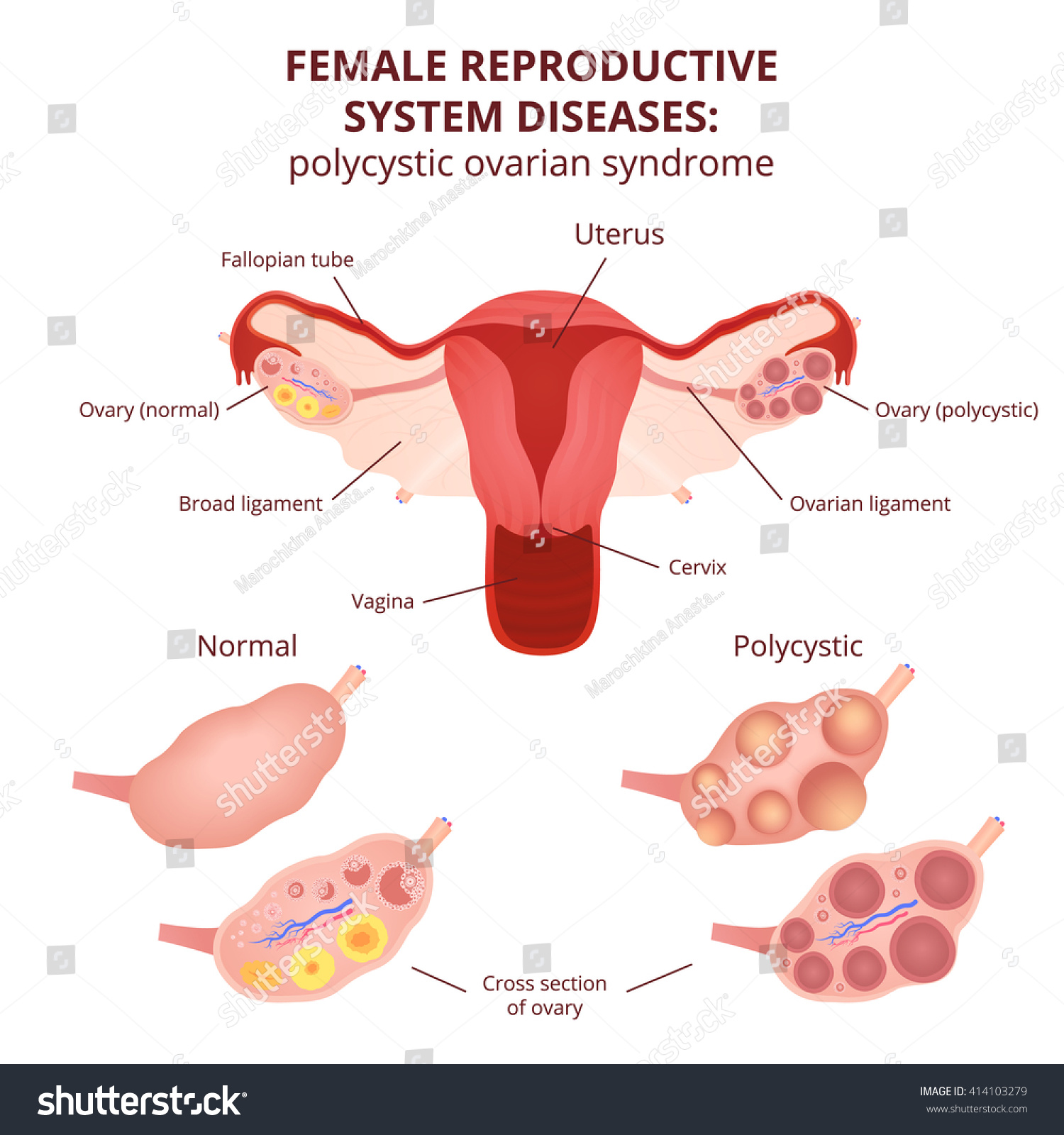 Vektor Stok Female Reproductive System Uterus Ovaries Scheme Tanpa Royalti 414103279 2051