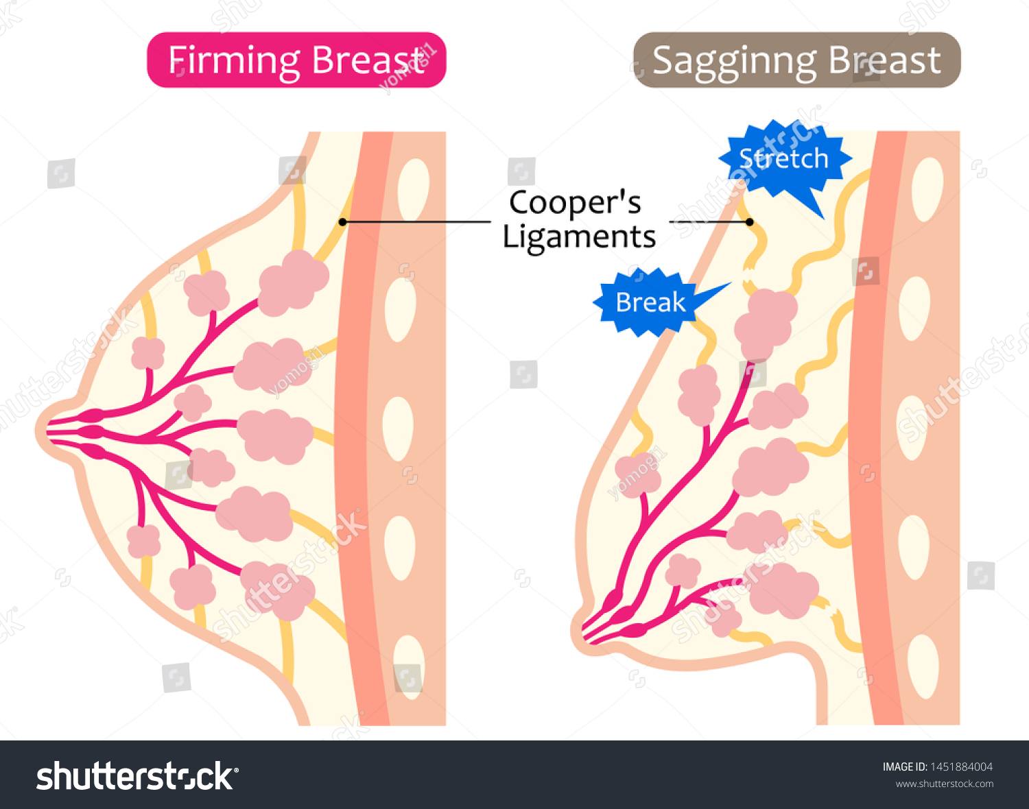Sagging Breast Pics
