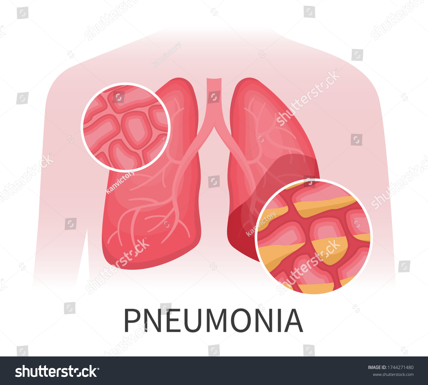 Flat Vector Illustration Human Lungs Pneumonia Stock Vector (Royalty ...