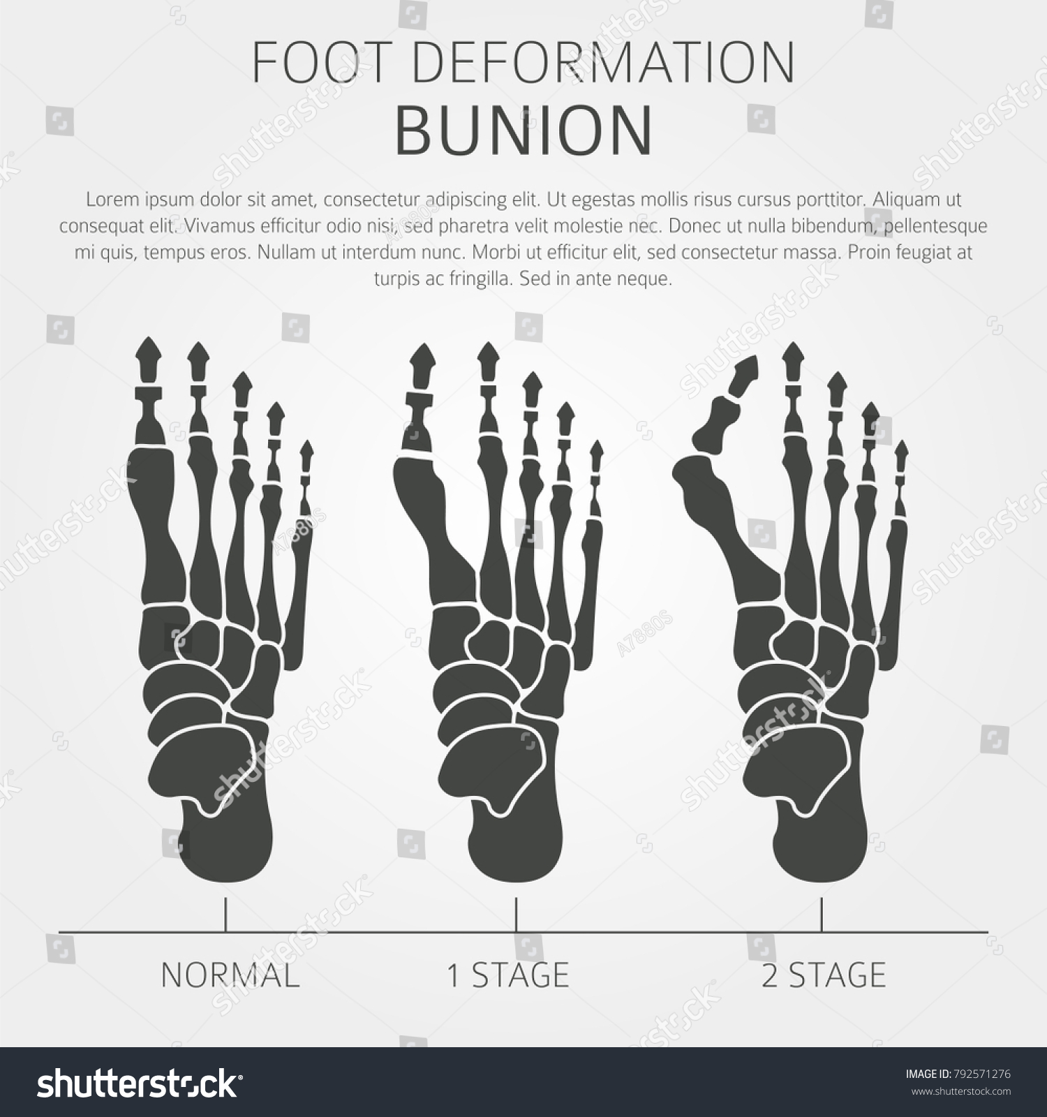 Foot Deformation Medical Desease Infographic Causes Stock Vector ...