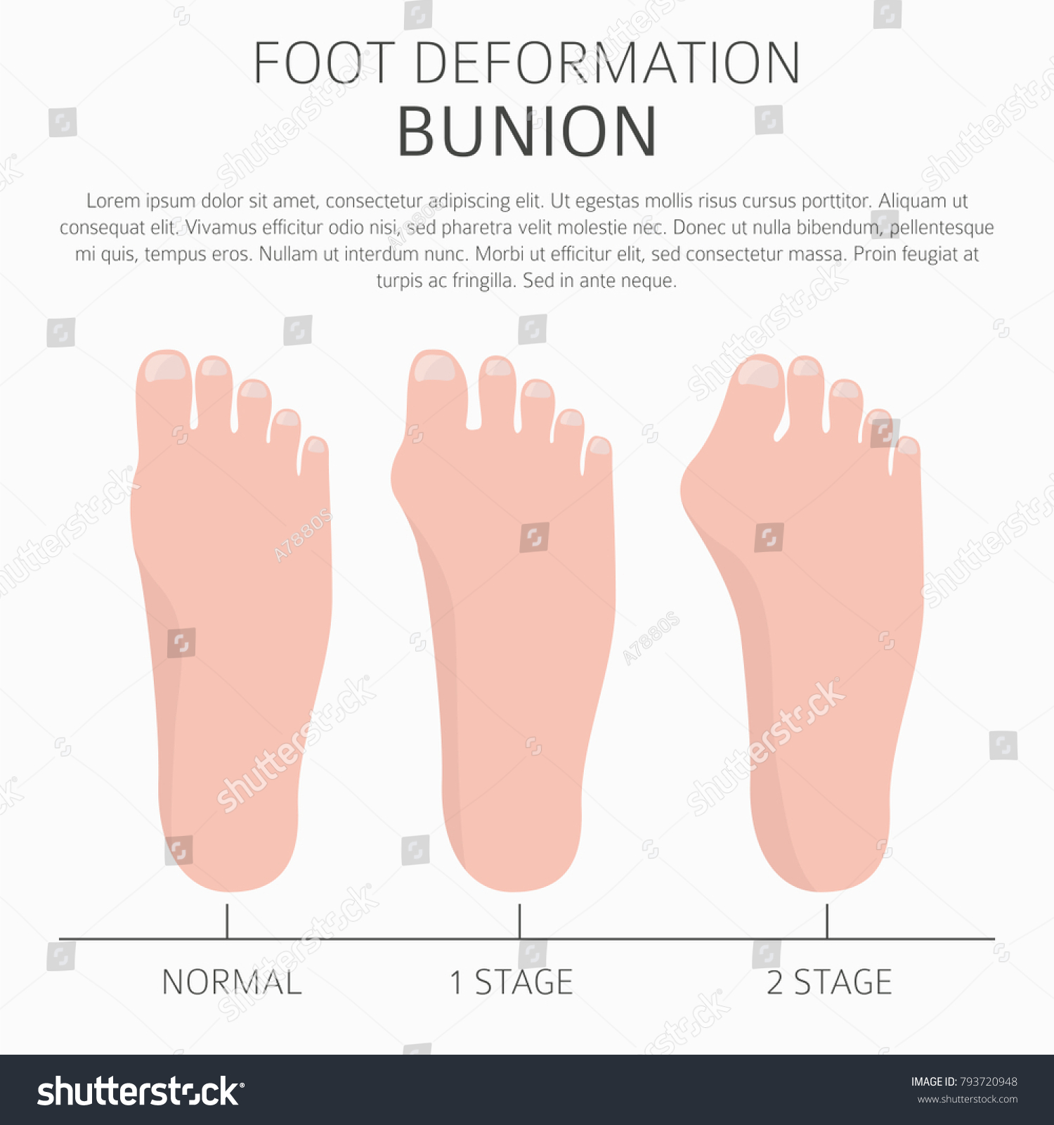 Foot Deformation Medical Desease Infographic Causes Stock Vector ...