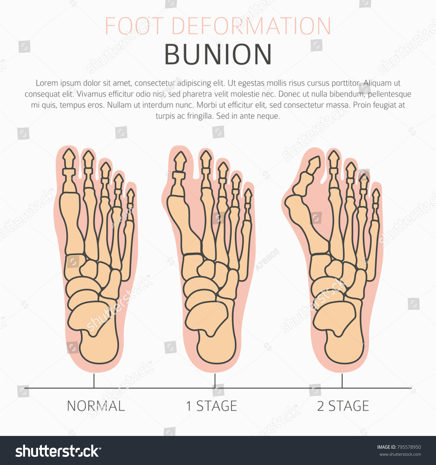 Foot Deformation Medical Desease Infographic Causes Stock Vector ...