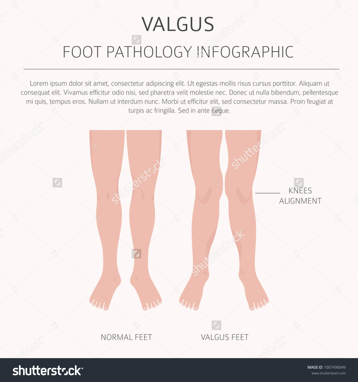 Foot Deformation Medical Desease Infographic Valgus Stock Vector