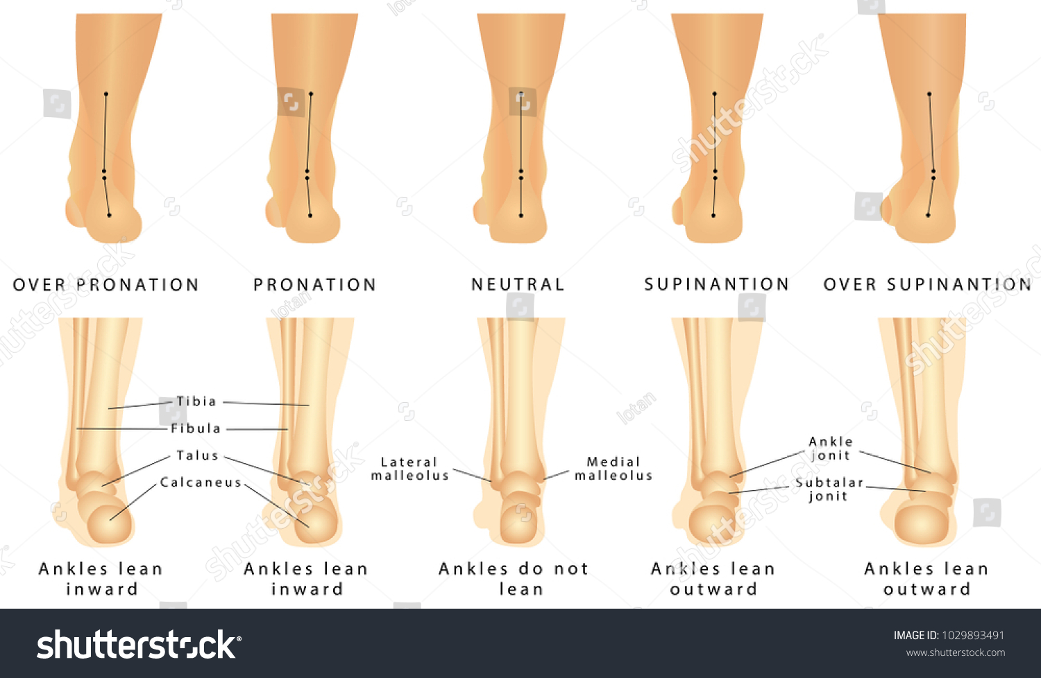 Foot Deformation Valgus Varus Defect Normal Stock Vector Royalty Free