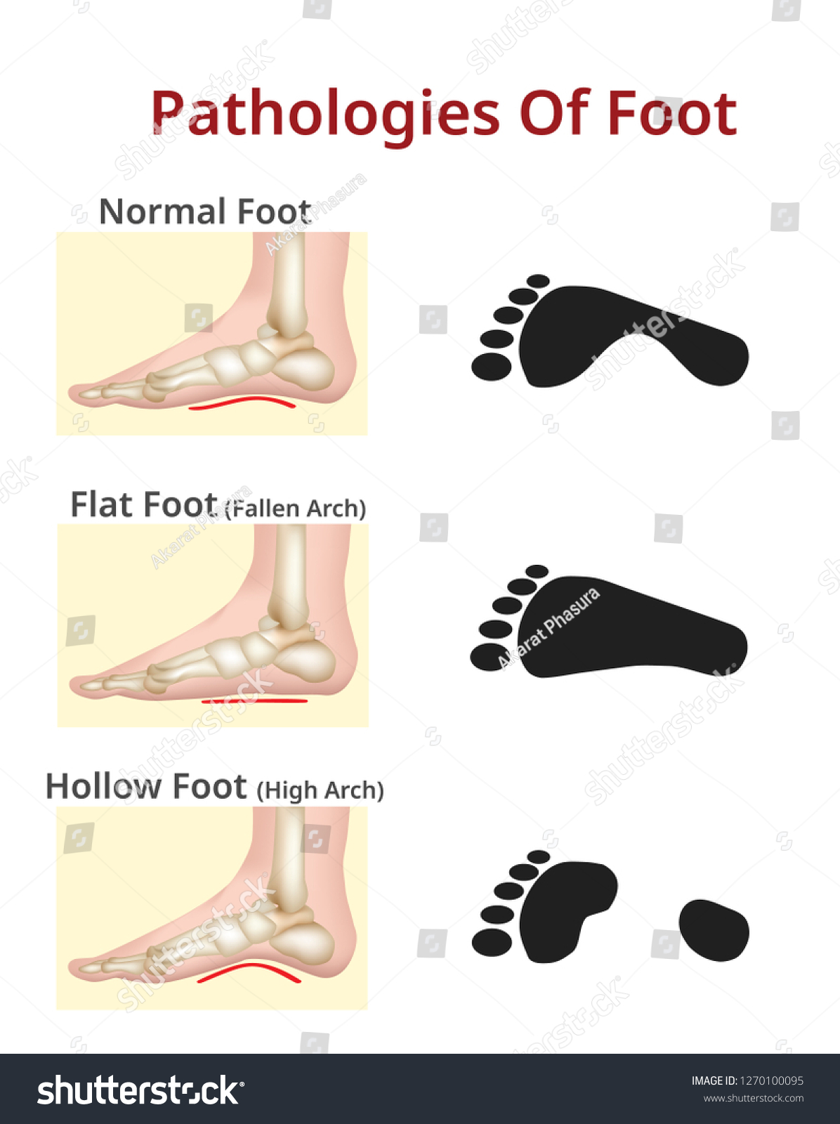 Foot Pathologies Normal Flat Hollow Foot Stock Vector (Royalty Free ...