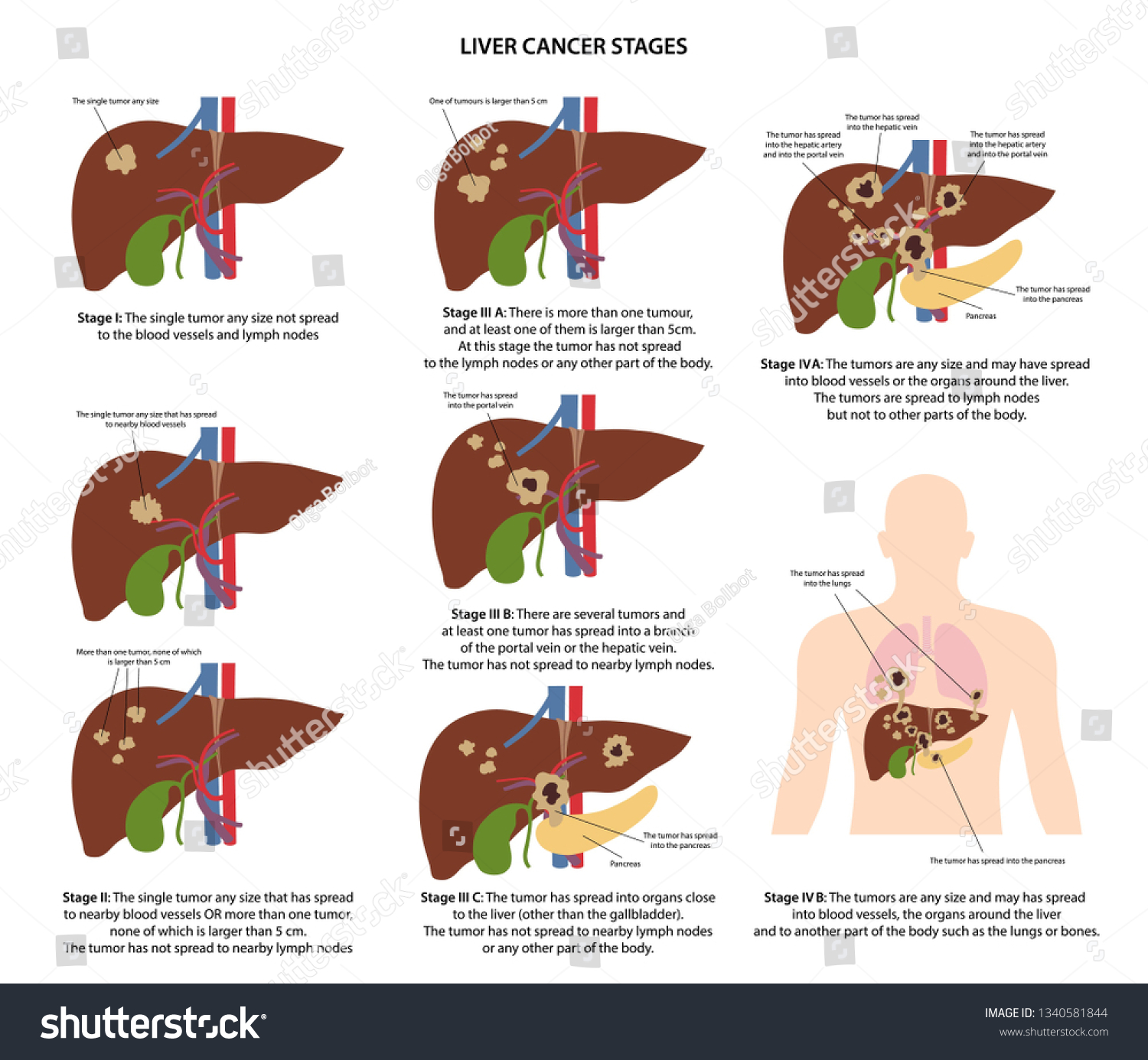 Four Stages Liver Cancer Description Corresponding 库存矢量图（免版税）1340581844