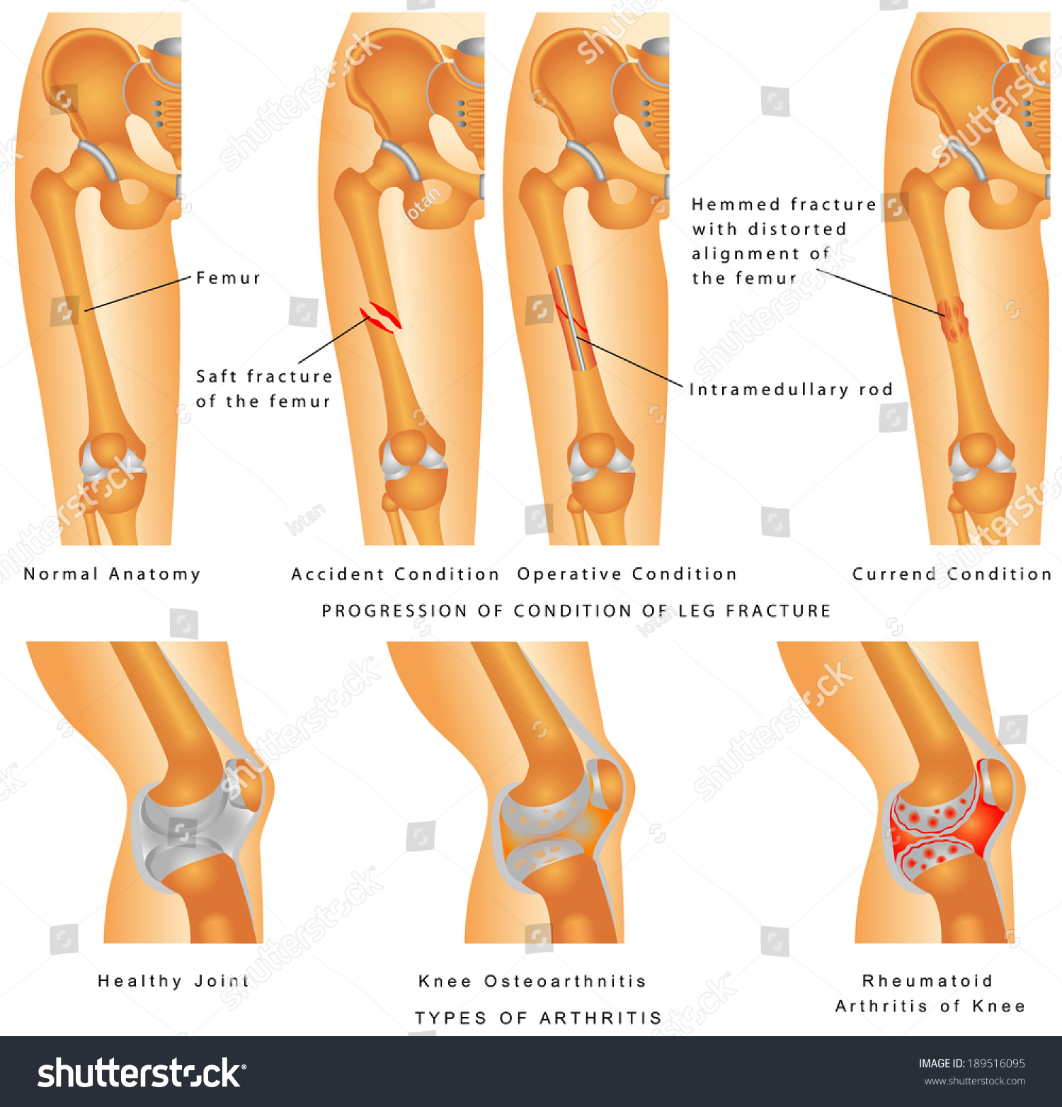 SVG of Fractures of Femur. Hemmed fracture with distorted alignment of the femur. Fixation of Femur Fracture with Placement of Intramedullary Rod. Types of Arthritis - Osteoarthritis, Rheumatoid Arthritis svg