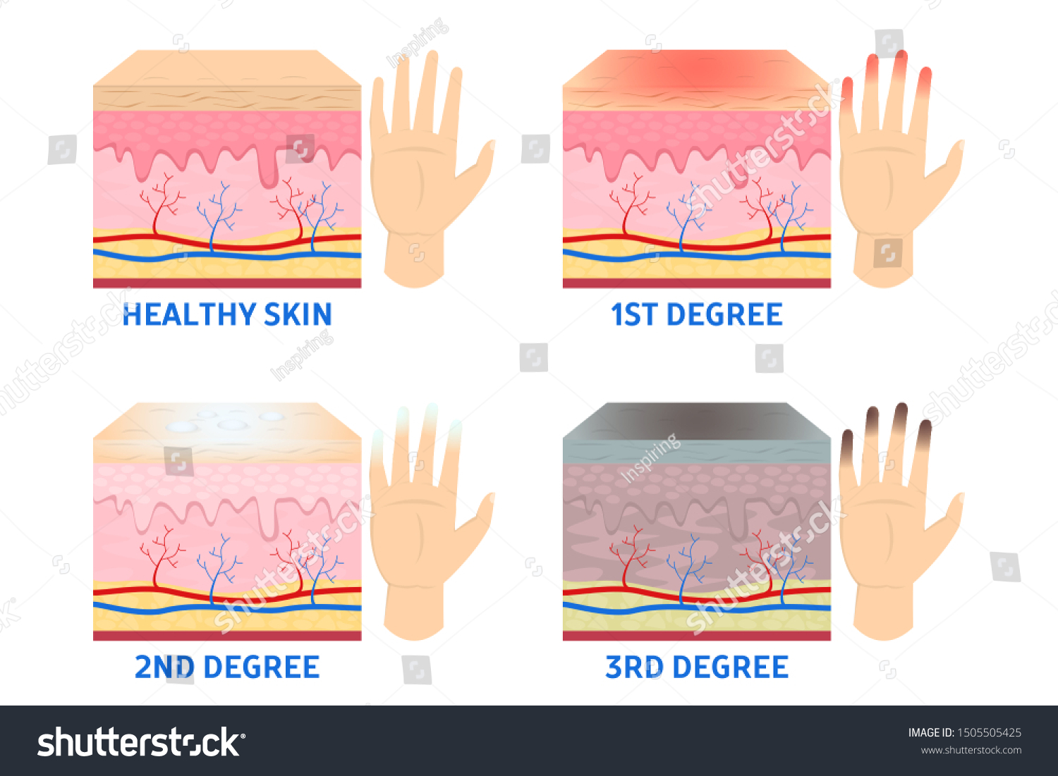 Frostbite stages. Frostbitten finger, hypothermia in cold season. Medical infographic. Blue and red fingers. Isolated vector illustration in cartoon style