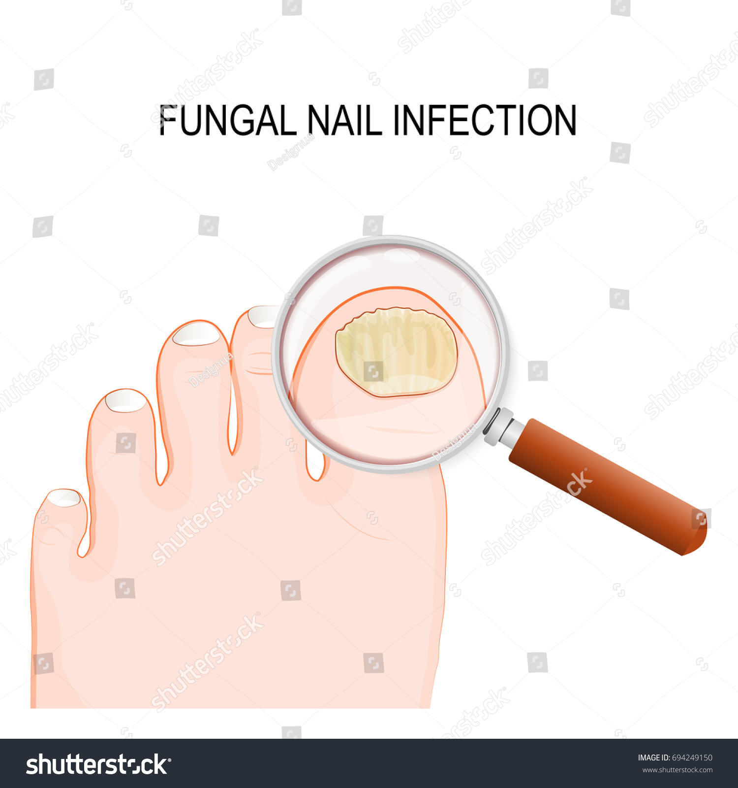 [DIAGRAM] Diagram Of Tinea Unguium - MYDIAGRAM.ONLINE