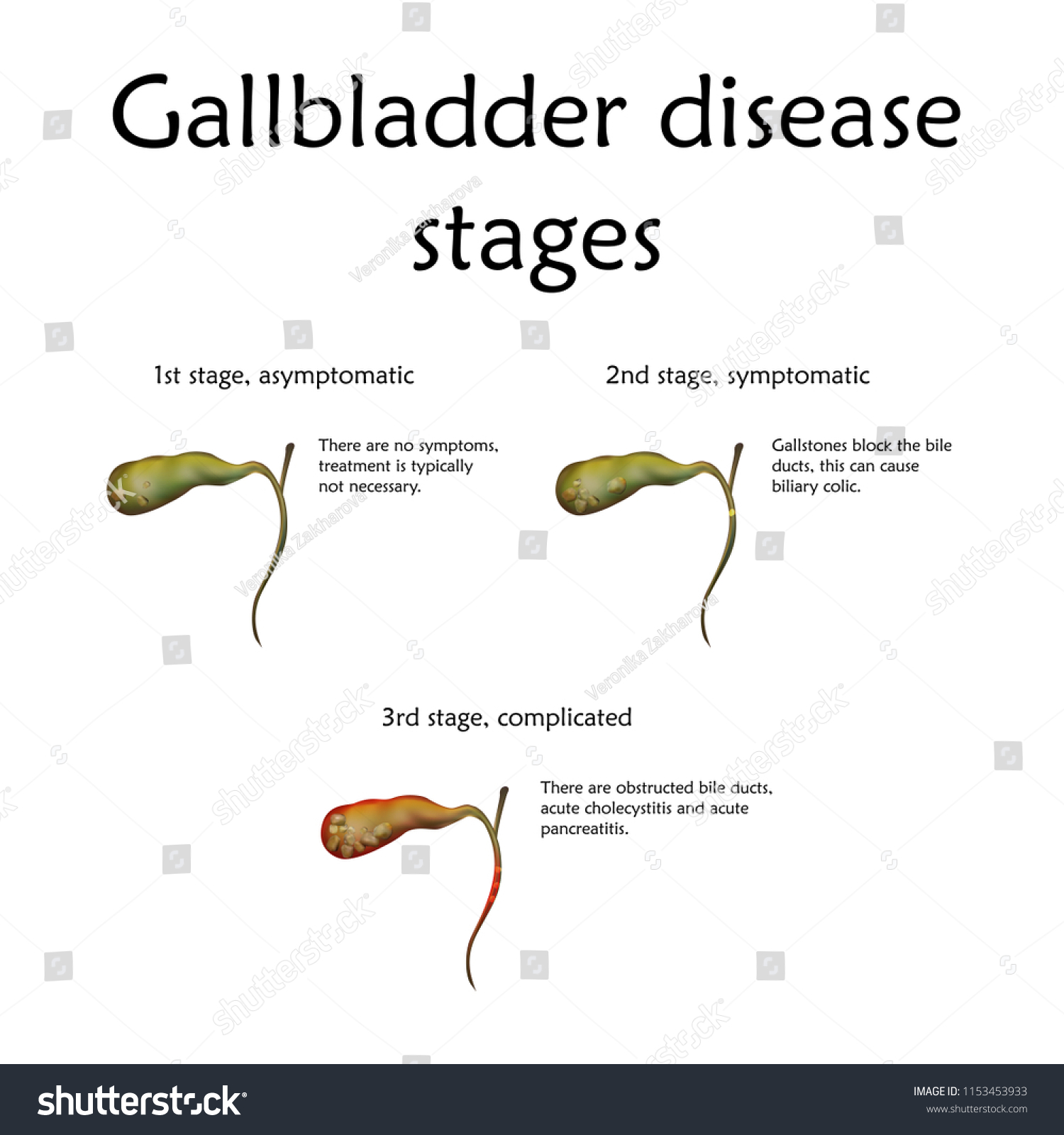 Bend of the gallbladder: causes, clinical manifestations, treatment Bend of the gallbladder: causes, clinical manifestations, treatment