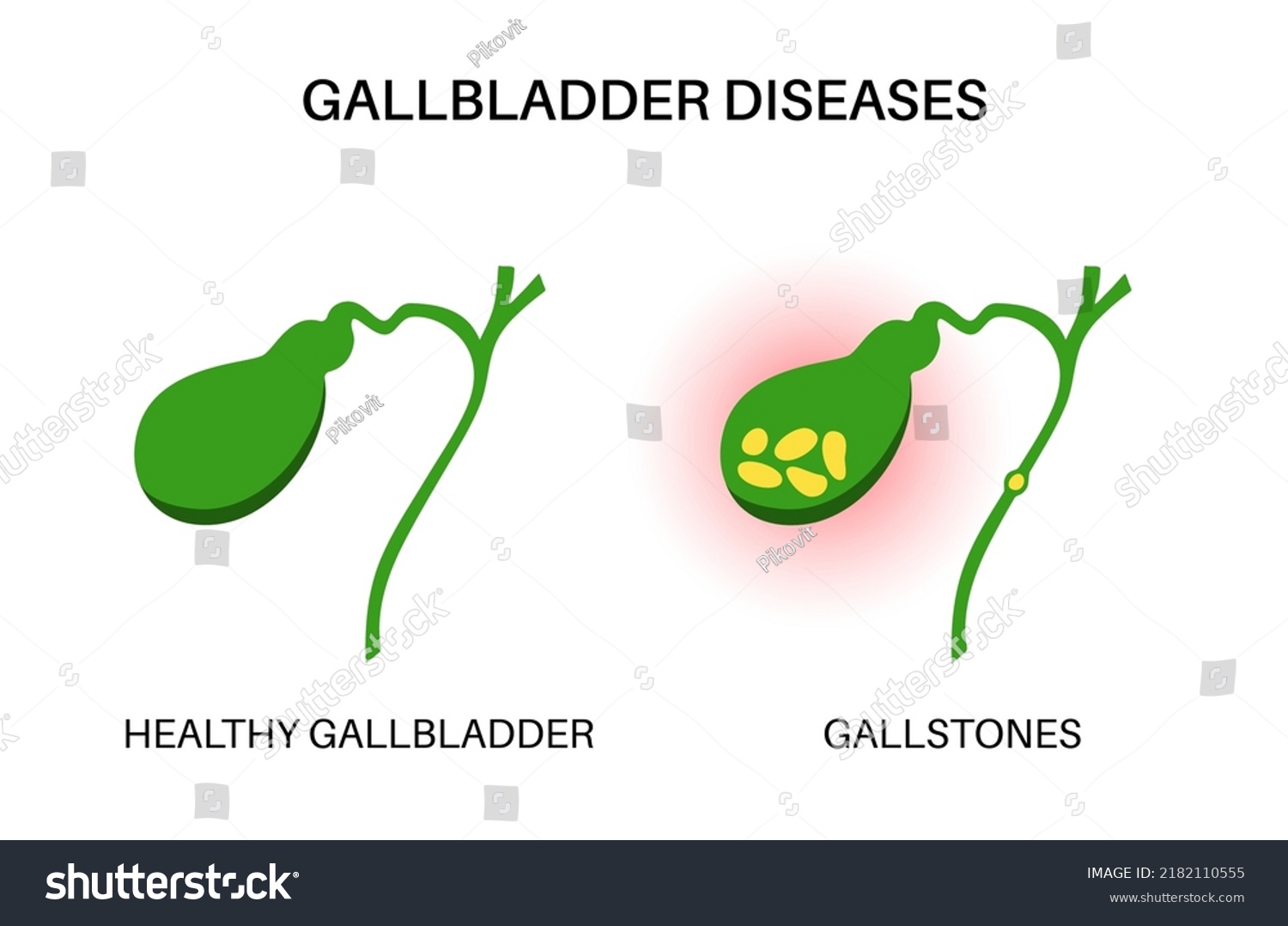 Gallstones Anatomy Inflamed Healthy Internal Organ Stock Vector ...
