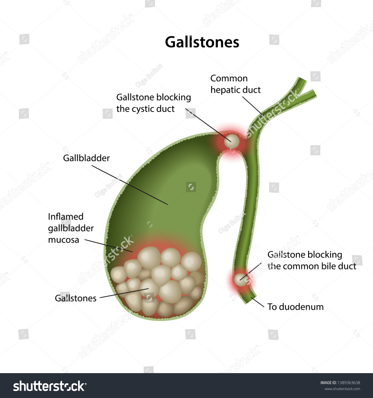 Gallstones Gallbladder Description Corresponding Parts Isolated: Vector ...