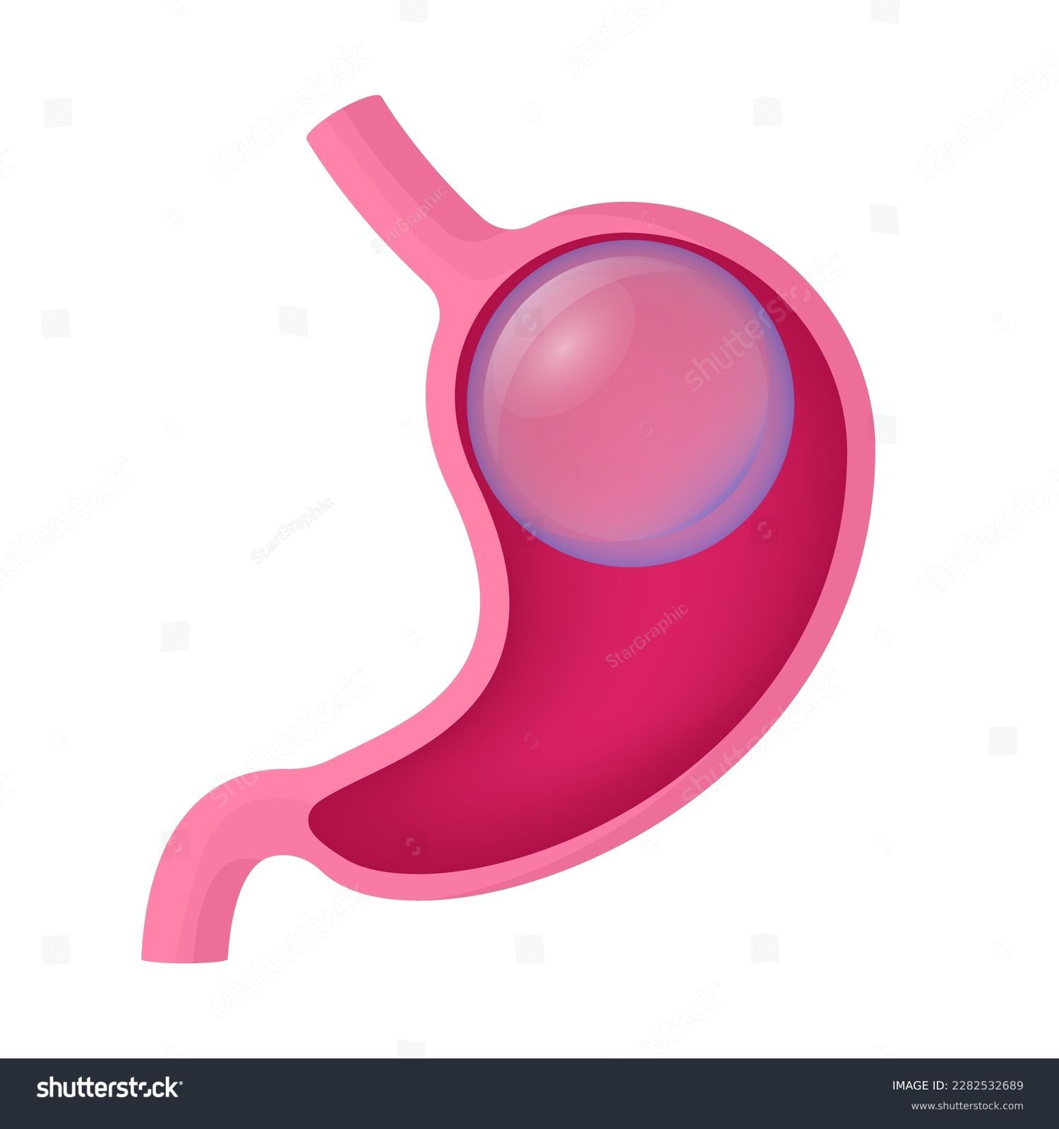 SVG of Gastric balloon weight loss. Installation of a gastric balloon into stomach. Methods of weight loss surgery. Human anatomy. Vector illustration. svg