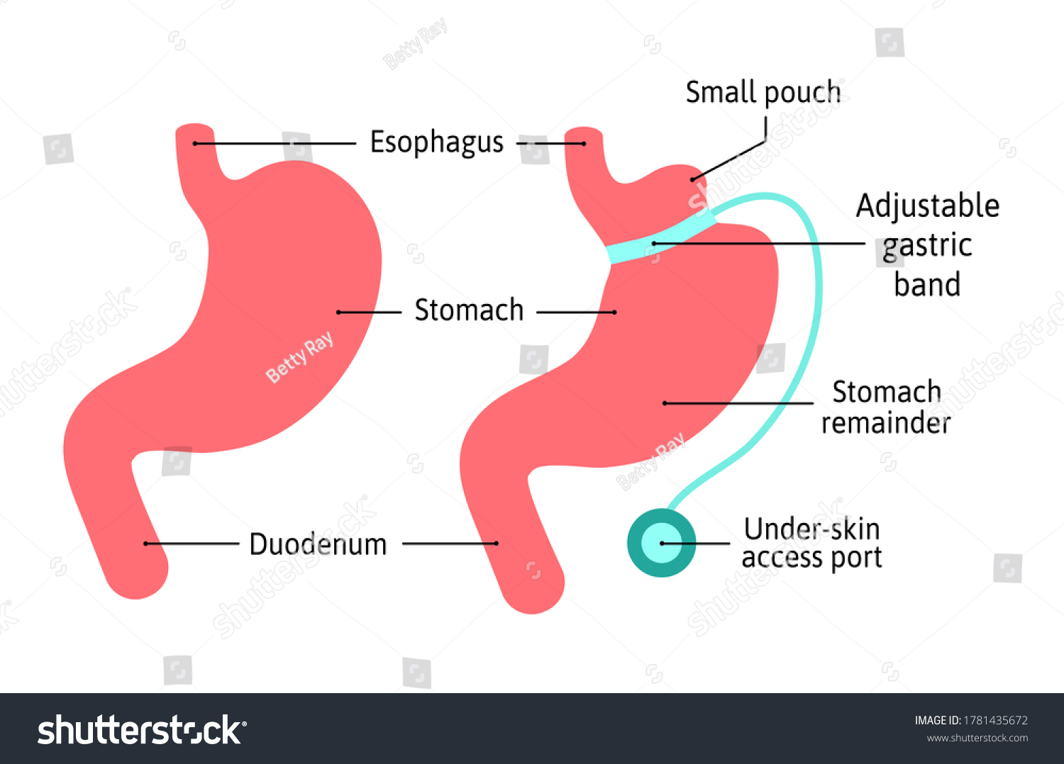 SVG of Gastric Band anatomical medical illustration diagram. Surgery divide stomach into two parts with band. Human stomach anatomy isolated on white background. Stomach and digestion organ system, vector svg