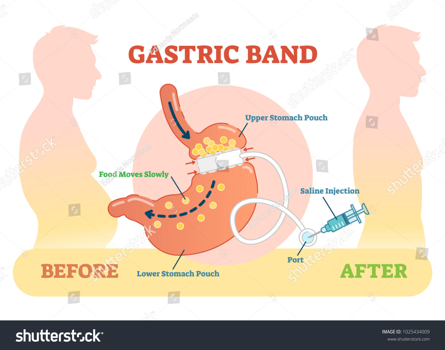 SVG of Gastric Band anatomical vector illustration diagram svg