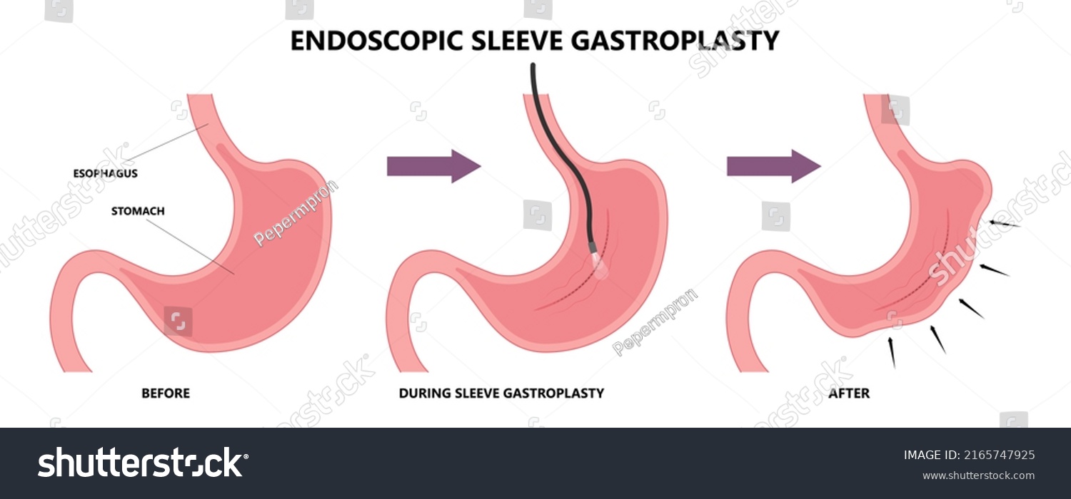 Gastric Bypass Surgery Band Roux En Stock Vector (Royalty Free ...