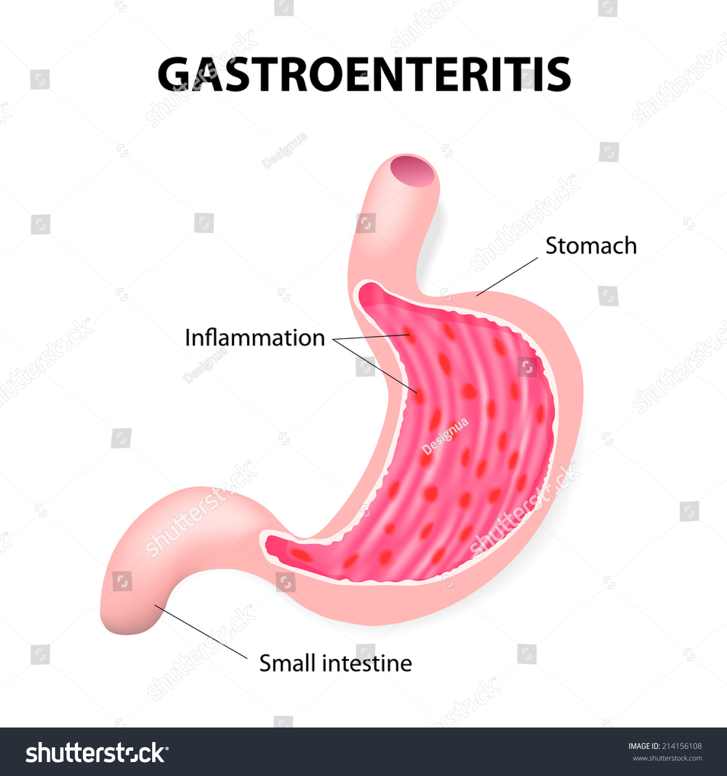 Gastroenteritis Stomach Virus Stomach Flu Gastric Stock Vector ...