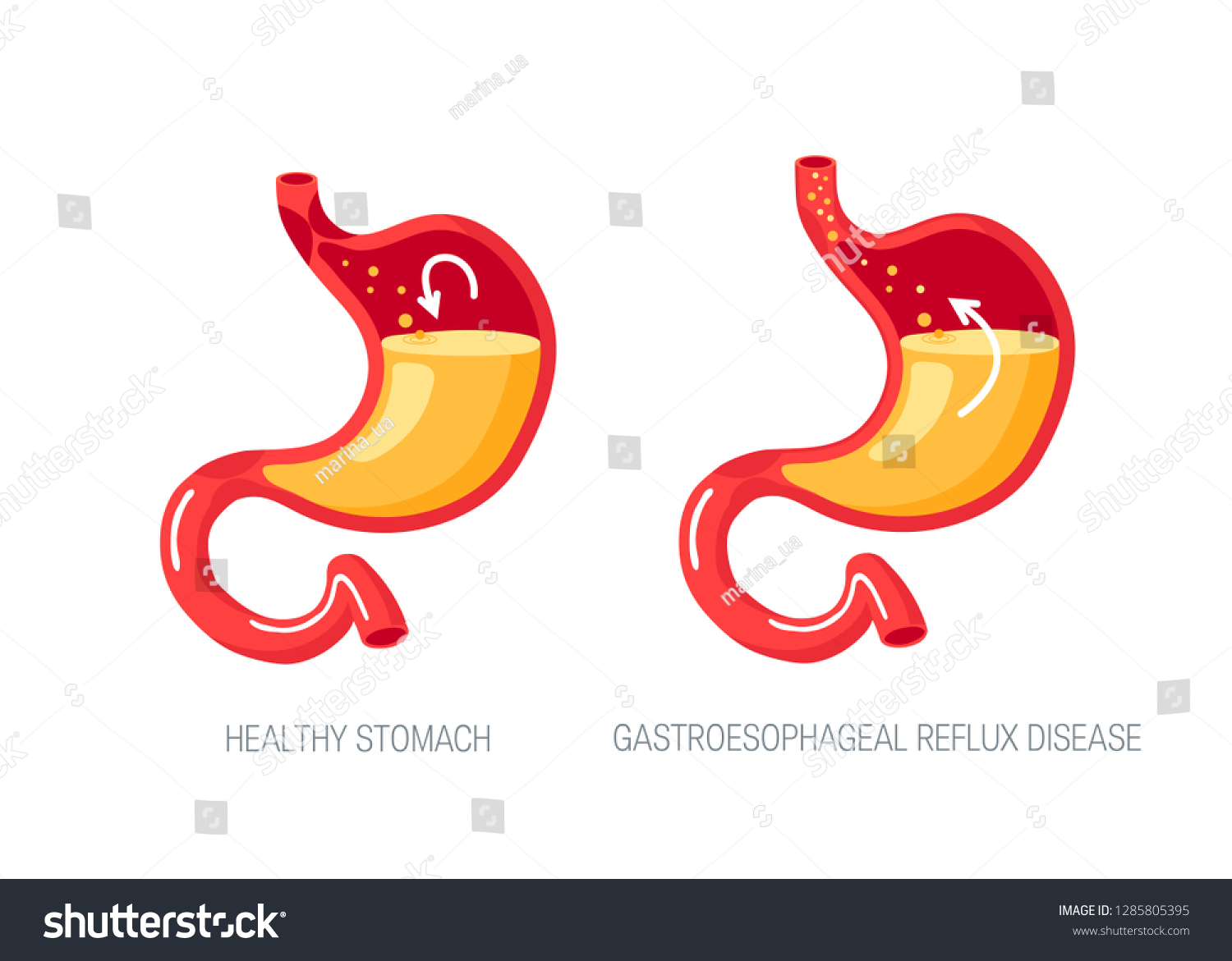 Gastroesophageal Reflux Disease Concept Stomach Gerd Stock Vector Royalty Free 1285805395