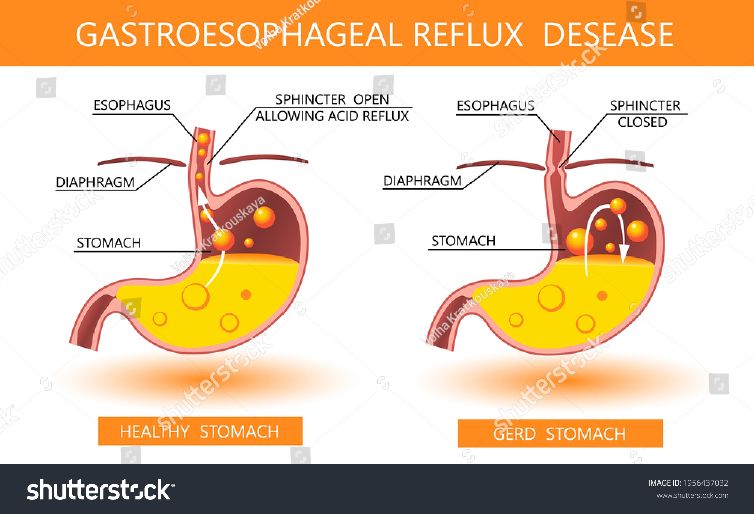 293 Acid reflux 3d Images, Stock Photos & Vectors | Shutterstock