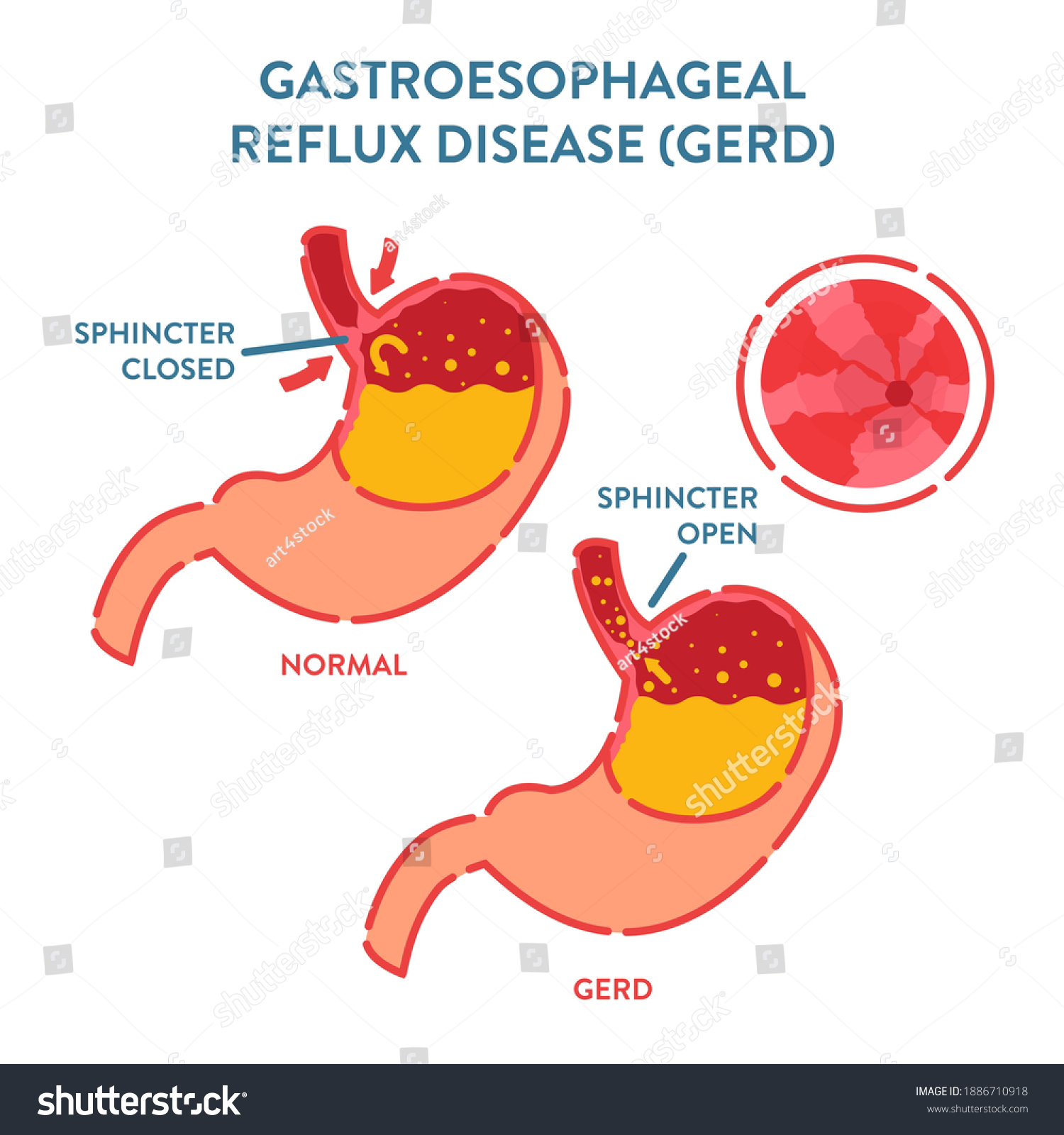 Gastroesophageal Reflux Disease Diagnostics Poster Endoscopic Stock Vector Royalty Free 4003