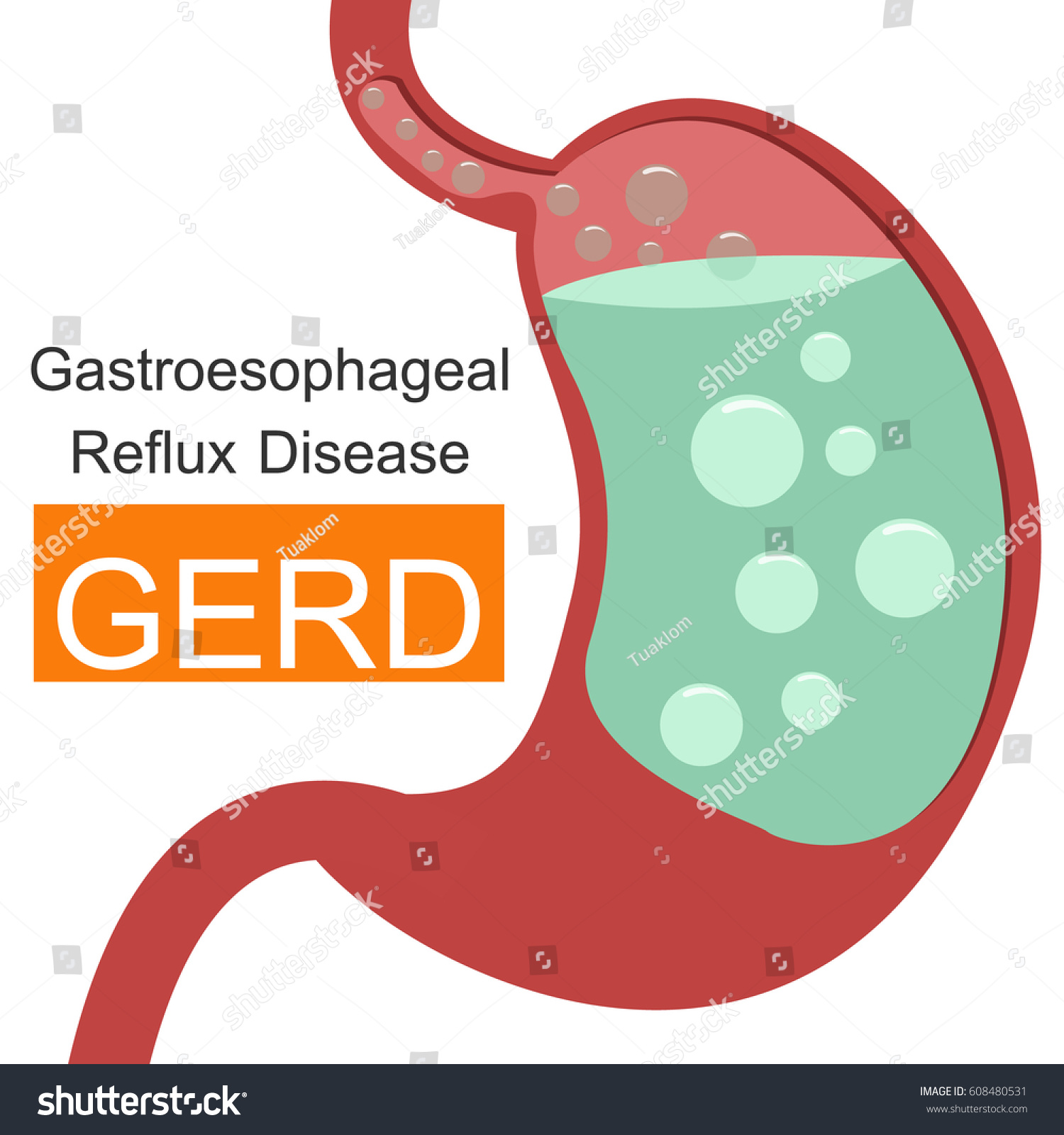 Gastroesophageal Reflux Disease Gerd Infographic Stock Vector Royalty Free 608480531