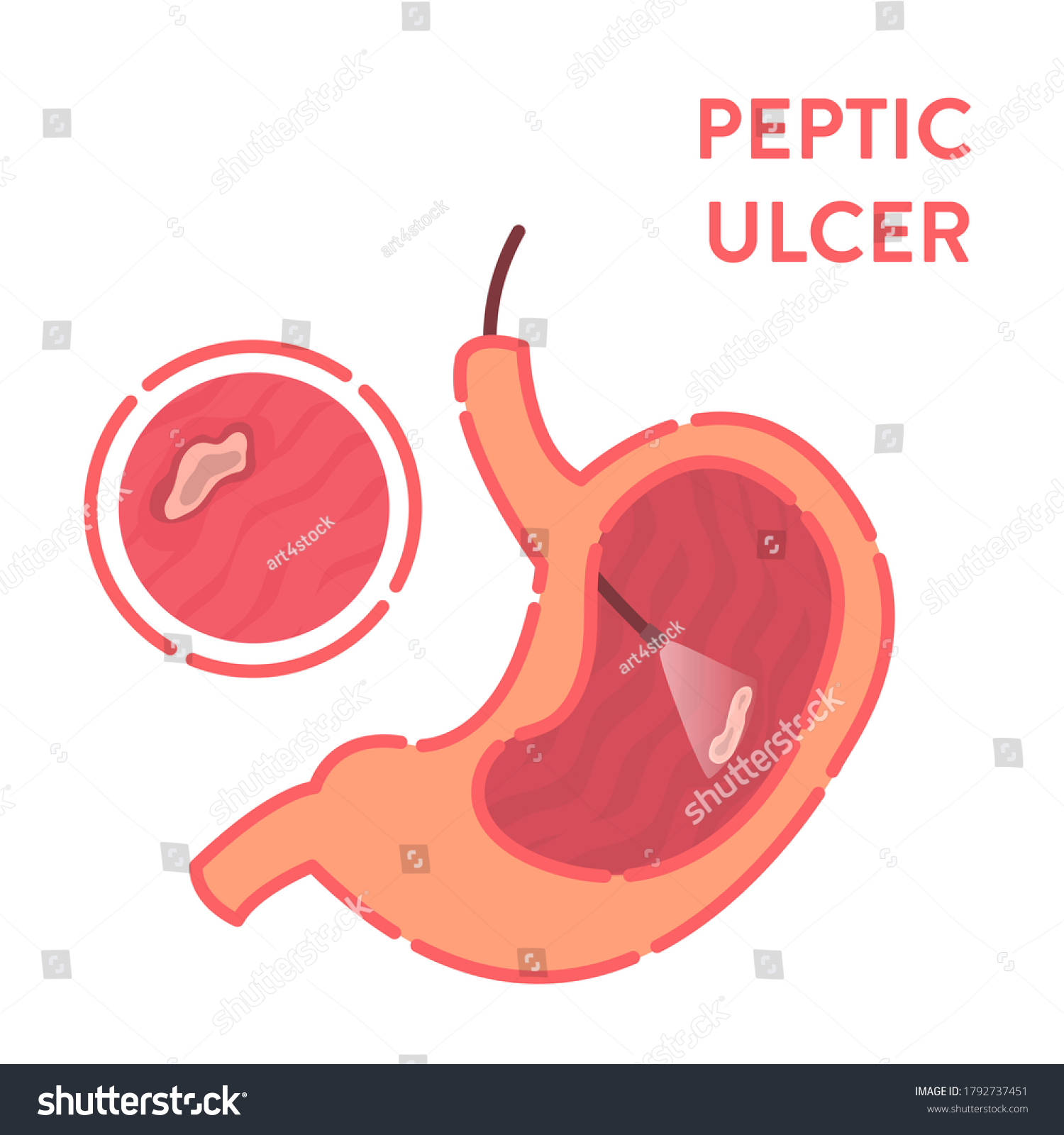 Gastroscopy Procedure Stomach Peptic Ulcer Disease Stock Vector ...