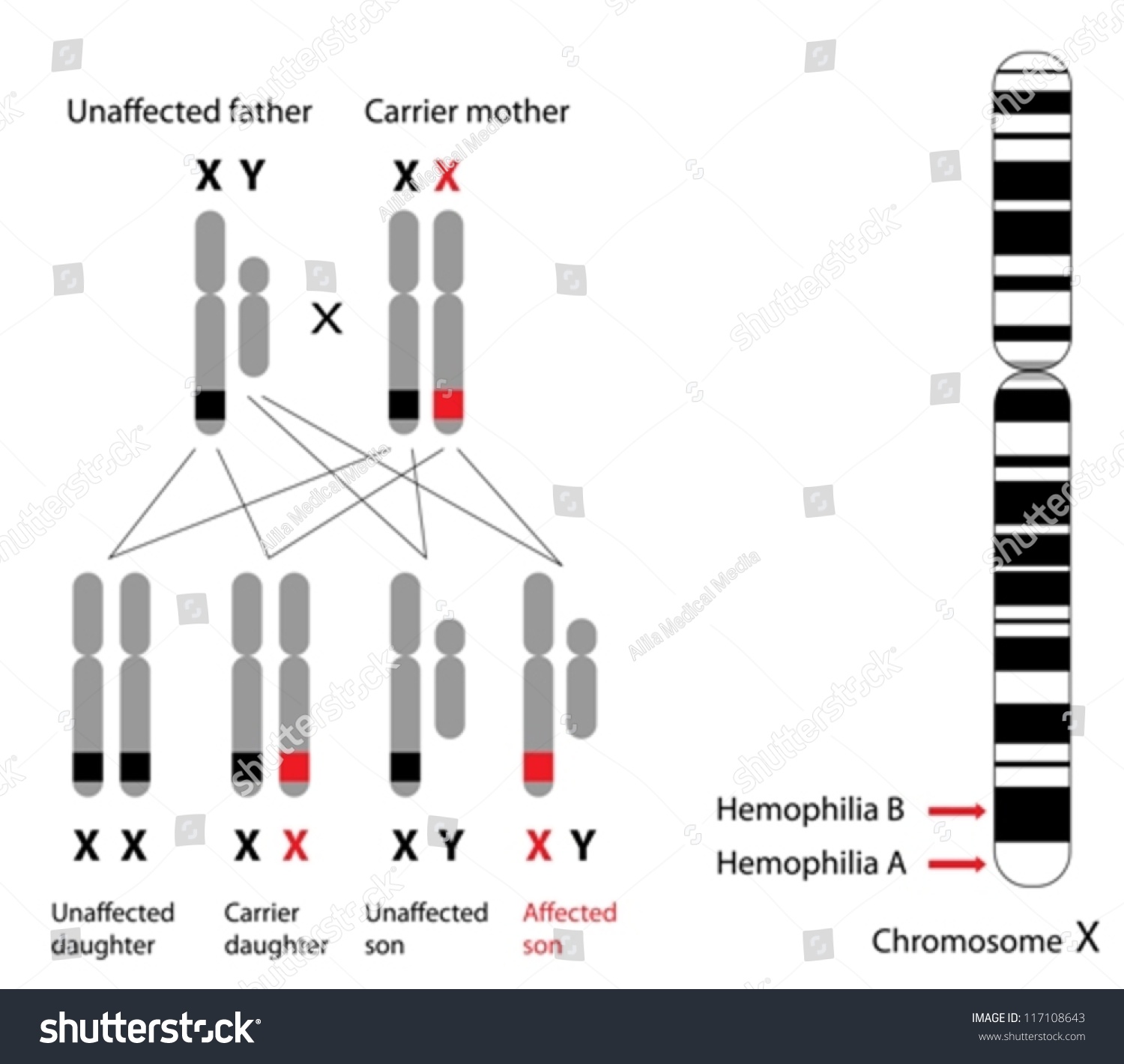 hemophilia genetics