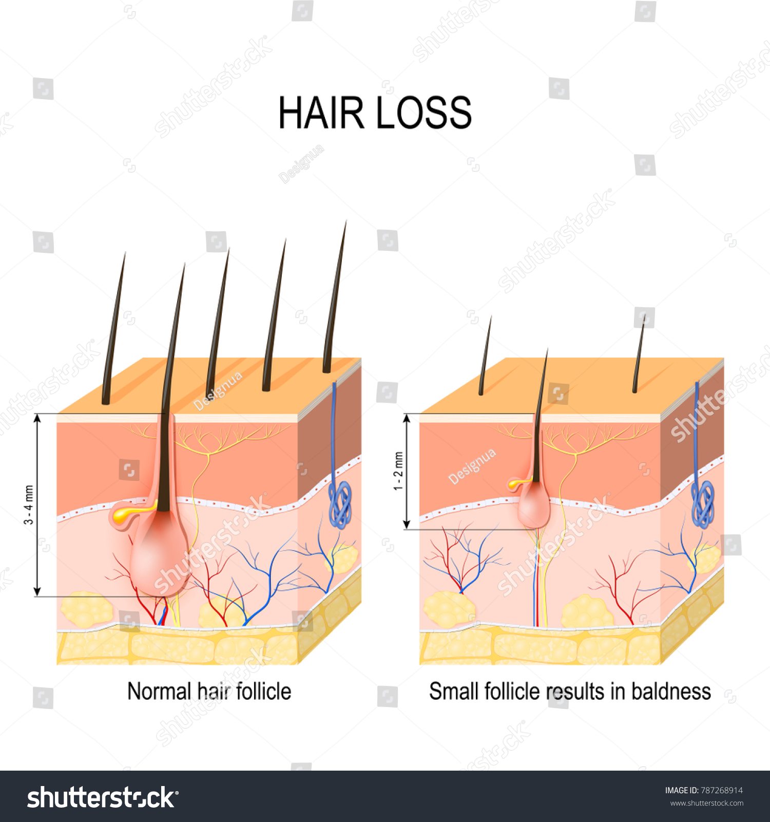 Hair Loss Baldness Normal Hair Follicle Stock Vector (Royalty Free ...