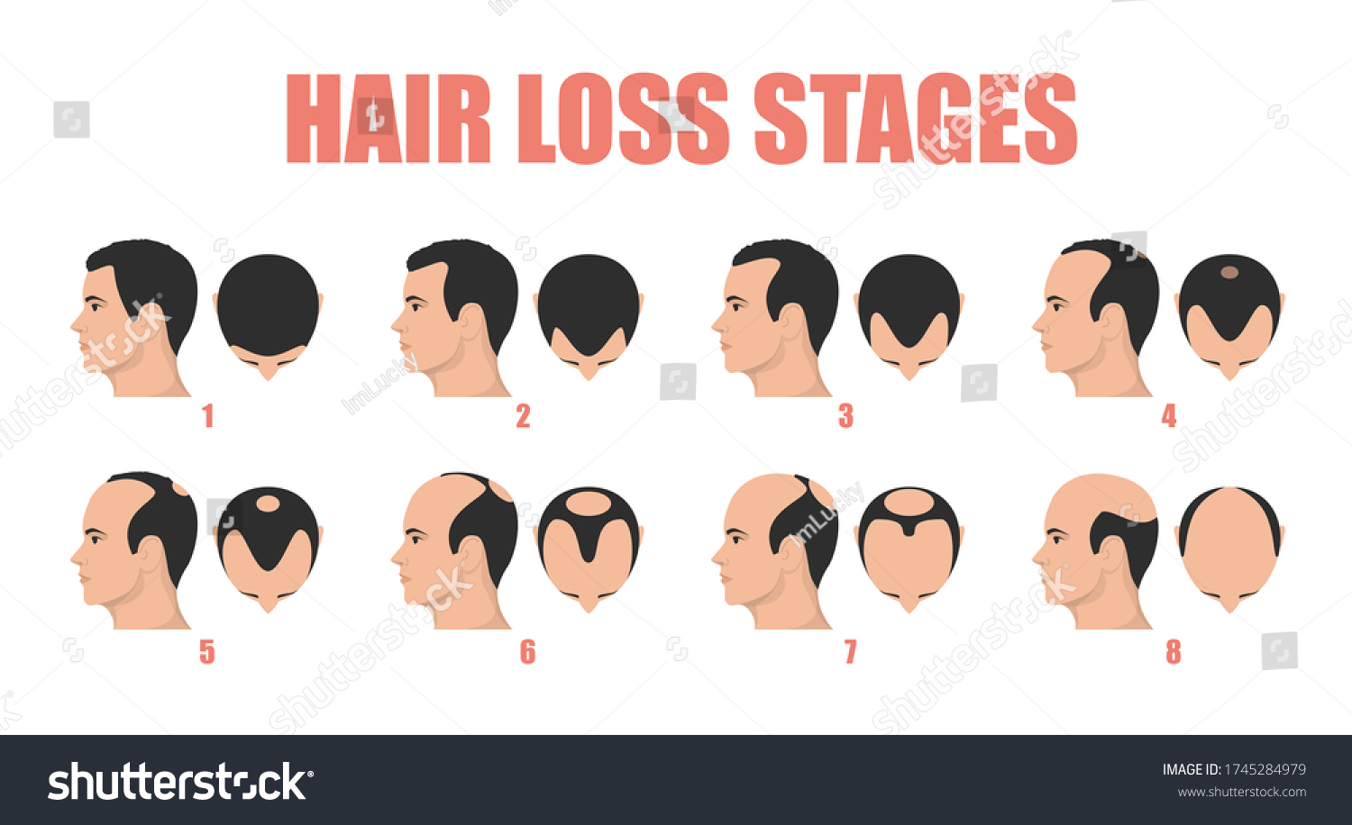 Hair Loss Stages Vector Isolated Male Stock Vector (Royalty Free ...