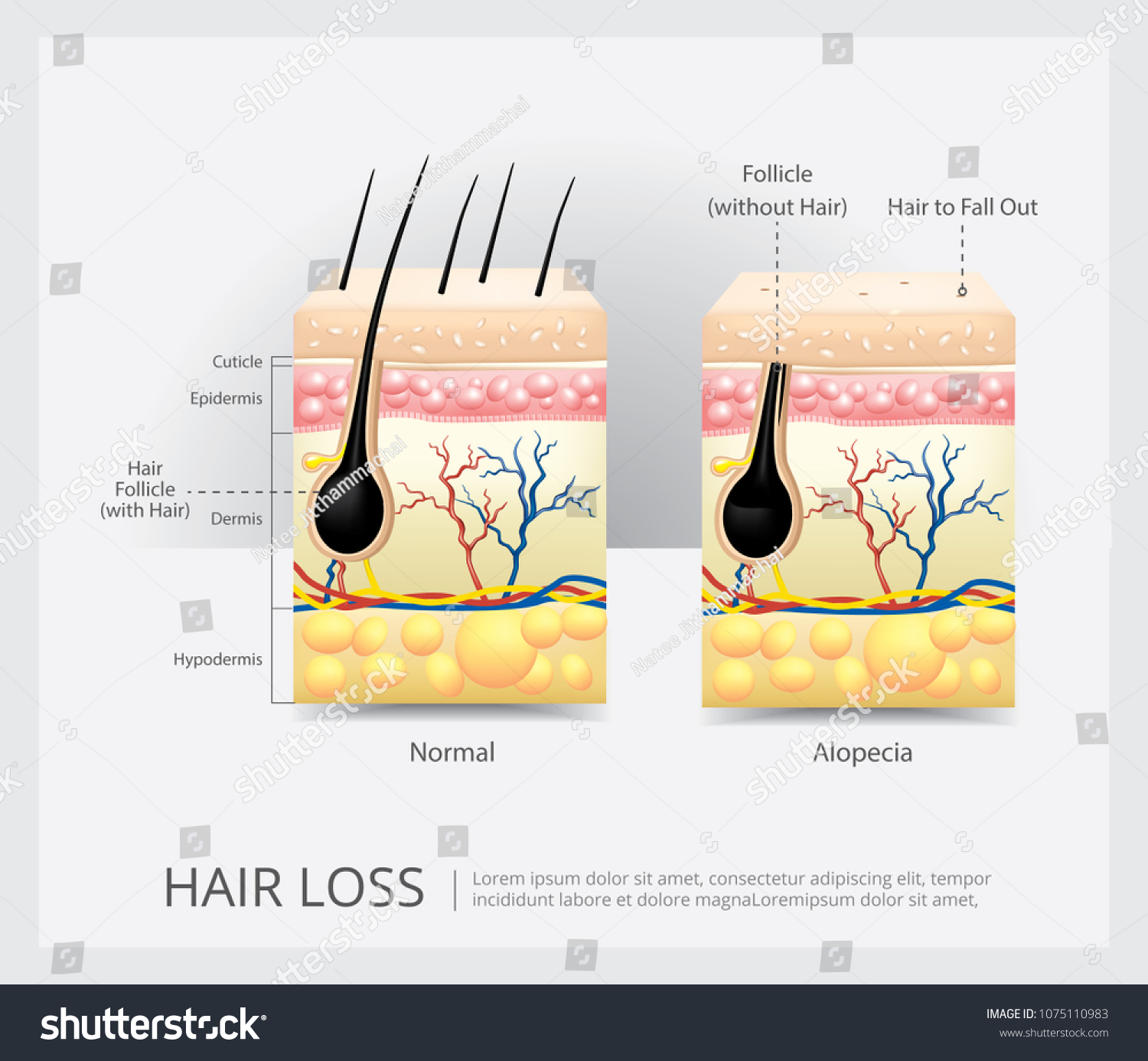 Hair Loss Structure Vector Illustration Stock Vector (Royalty Free ...