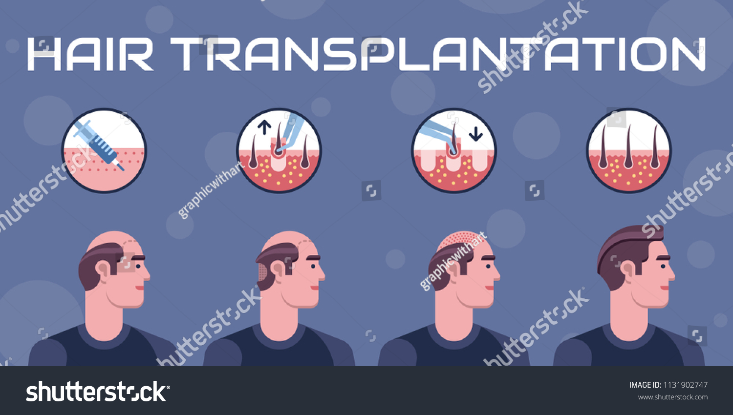 223 Hair Transplant Steps Images, Stock Photos & Vectors 