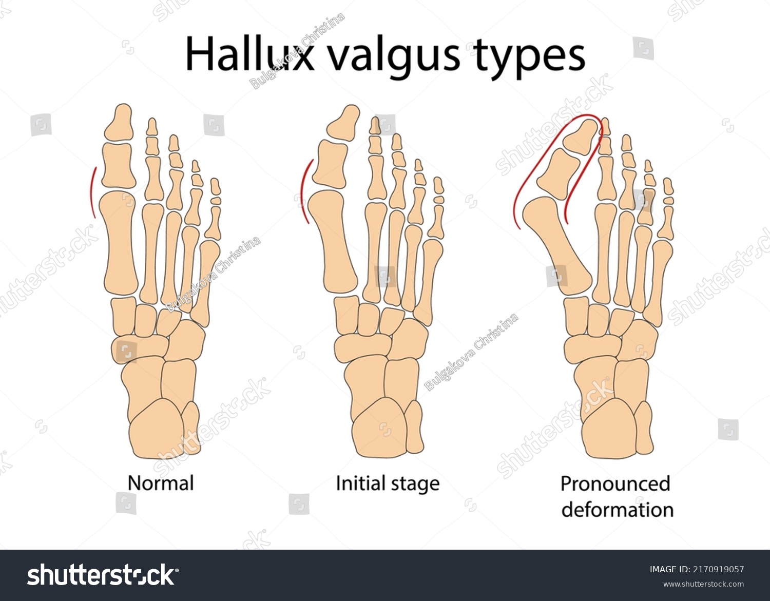 Hallux Valgus Medical Infographic Vector Illustration Stock Vector ...