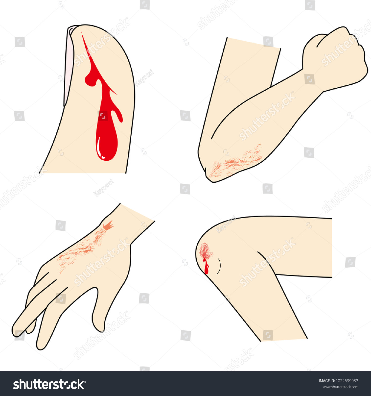 Hand Foot Injuries Stock Vector (Royalty Free) 1022699083