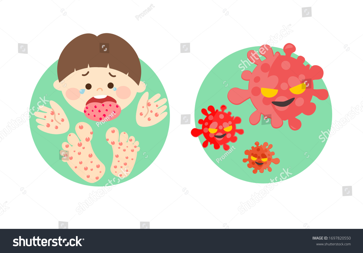 Hand Foot Mouth Disease Vector Stock Vector (Royalty Free) 1697820550 ...