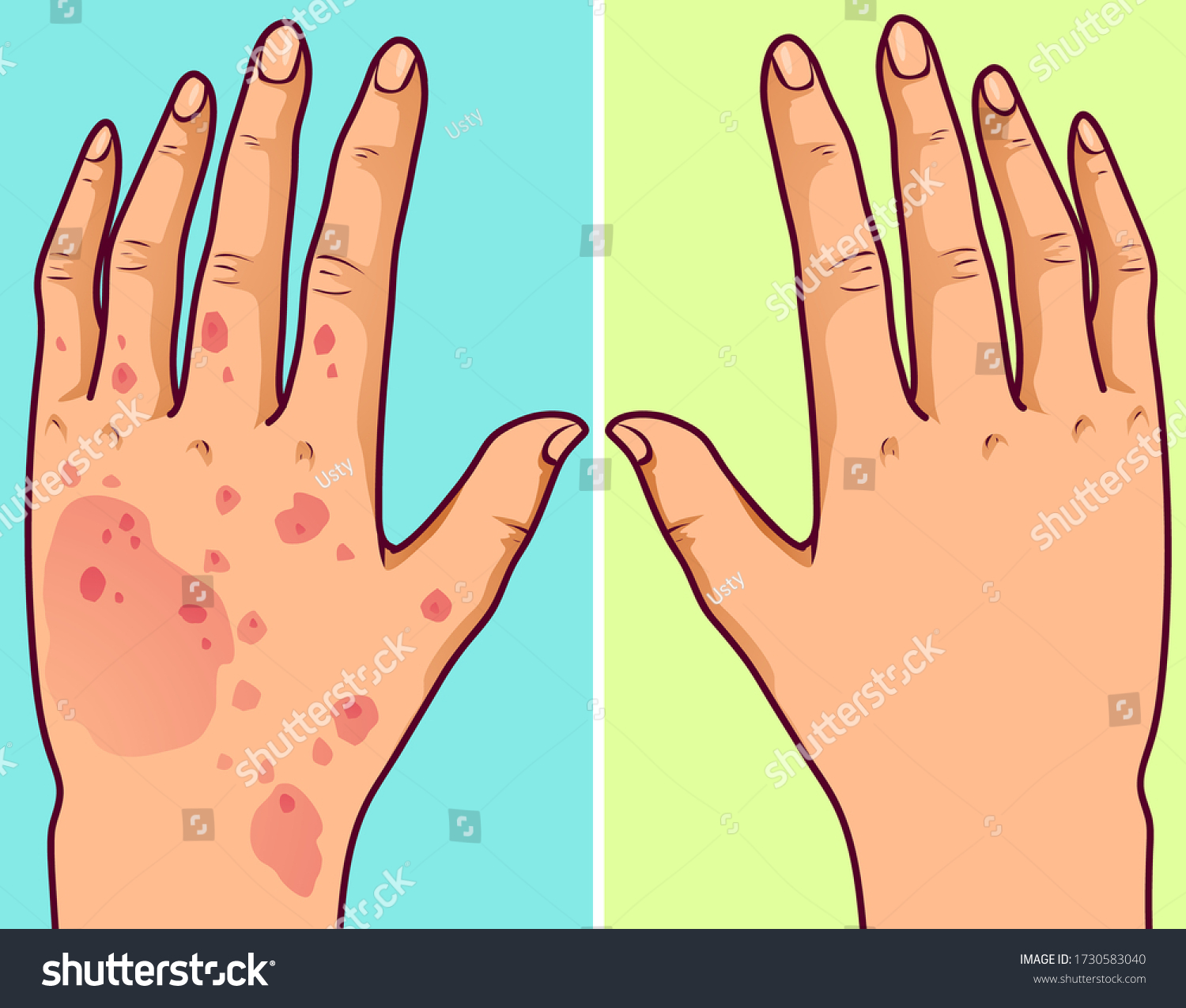 Hand Eczema Before After Stock Vector (Royalty Free) 1730583040 ...