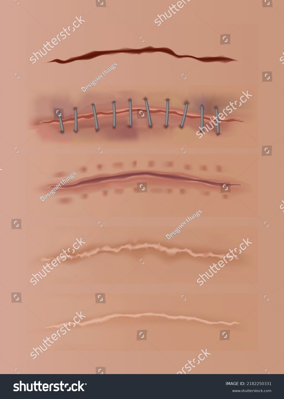 Healing Wounds Set Skin Scars Stitched Stock Vector (Royalty Free ...