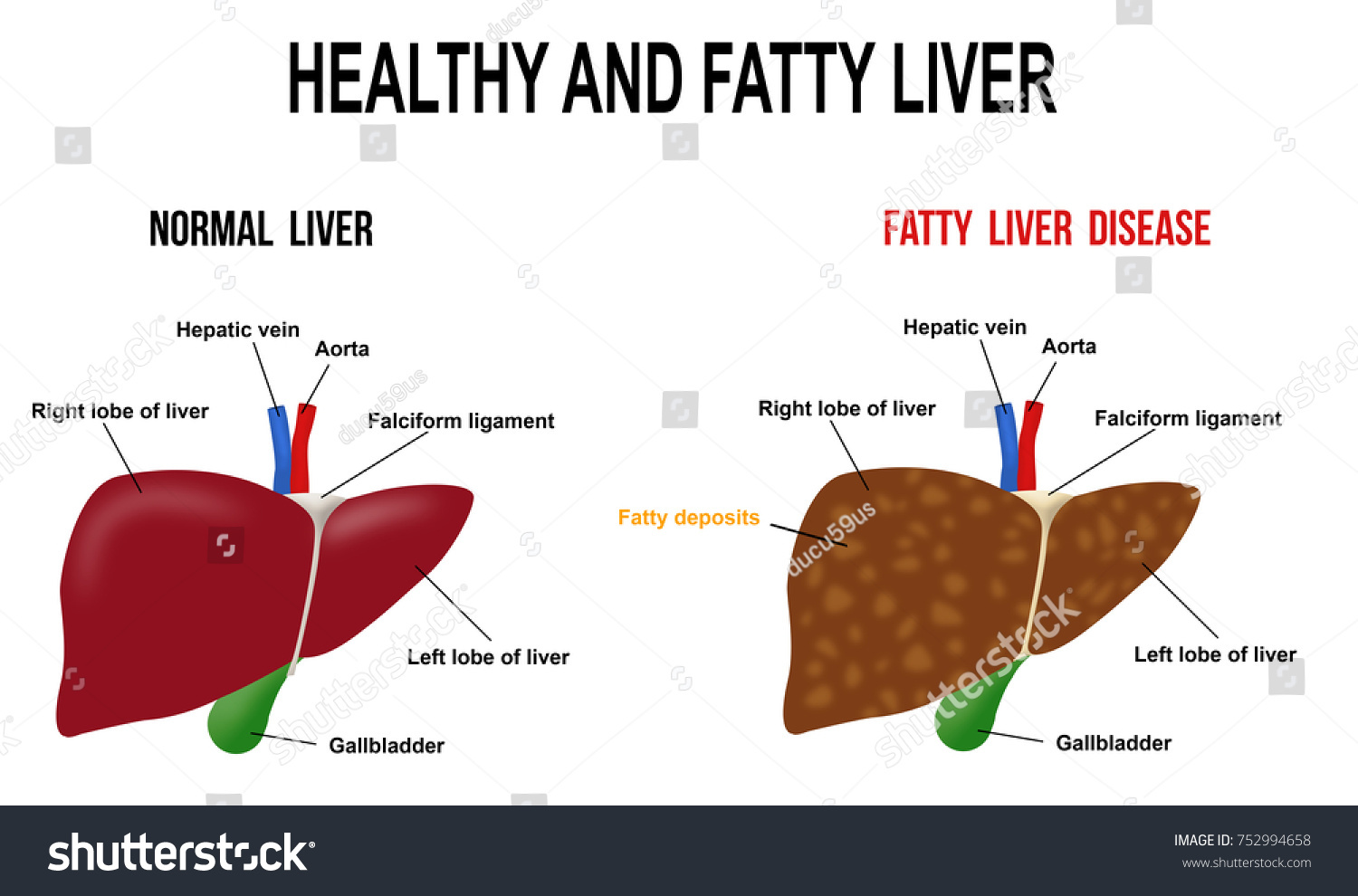 Healthy Fatty Liver Vector Illustration Basic Stock Vector Royalty Free Shutterstock