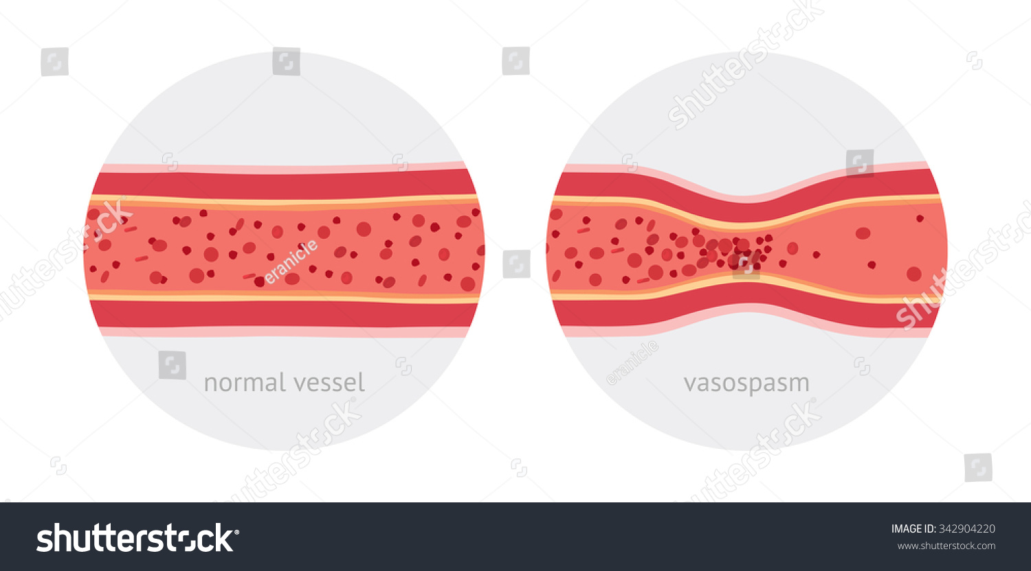 Healthy Sick Spasm Anatomical Vessels Blood Stock Vector 342904220 ...