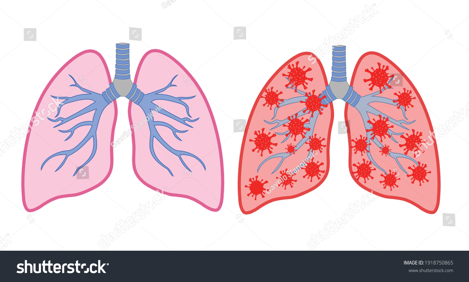 Healthy Lungs On Left Side Lungs Stock Vector (Royalty Free) 1918750865