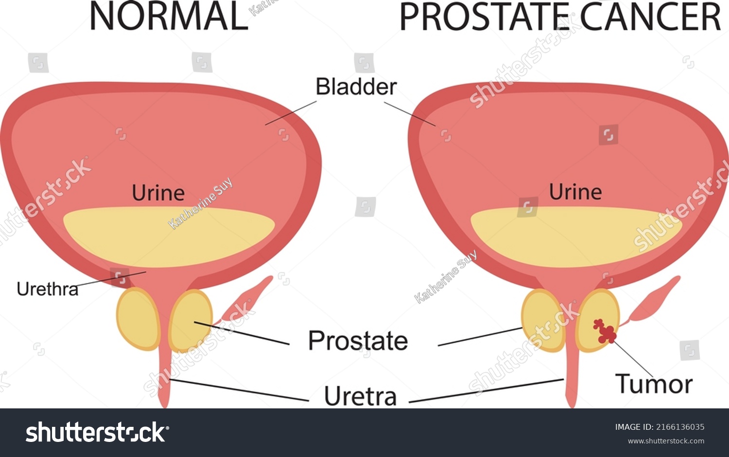 Healthy Prostate Prostate Cancer Illustration Male Stock Vector ...