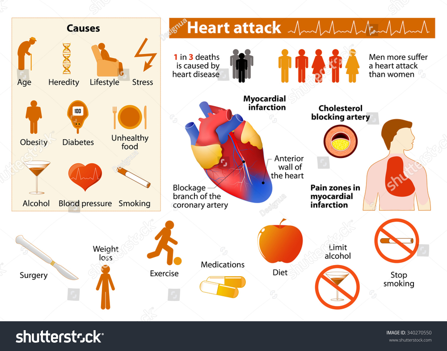 Heart Attack Infographics Low Color Style Stock Vector 340270550 ...