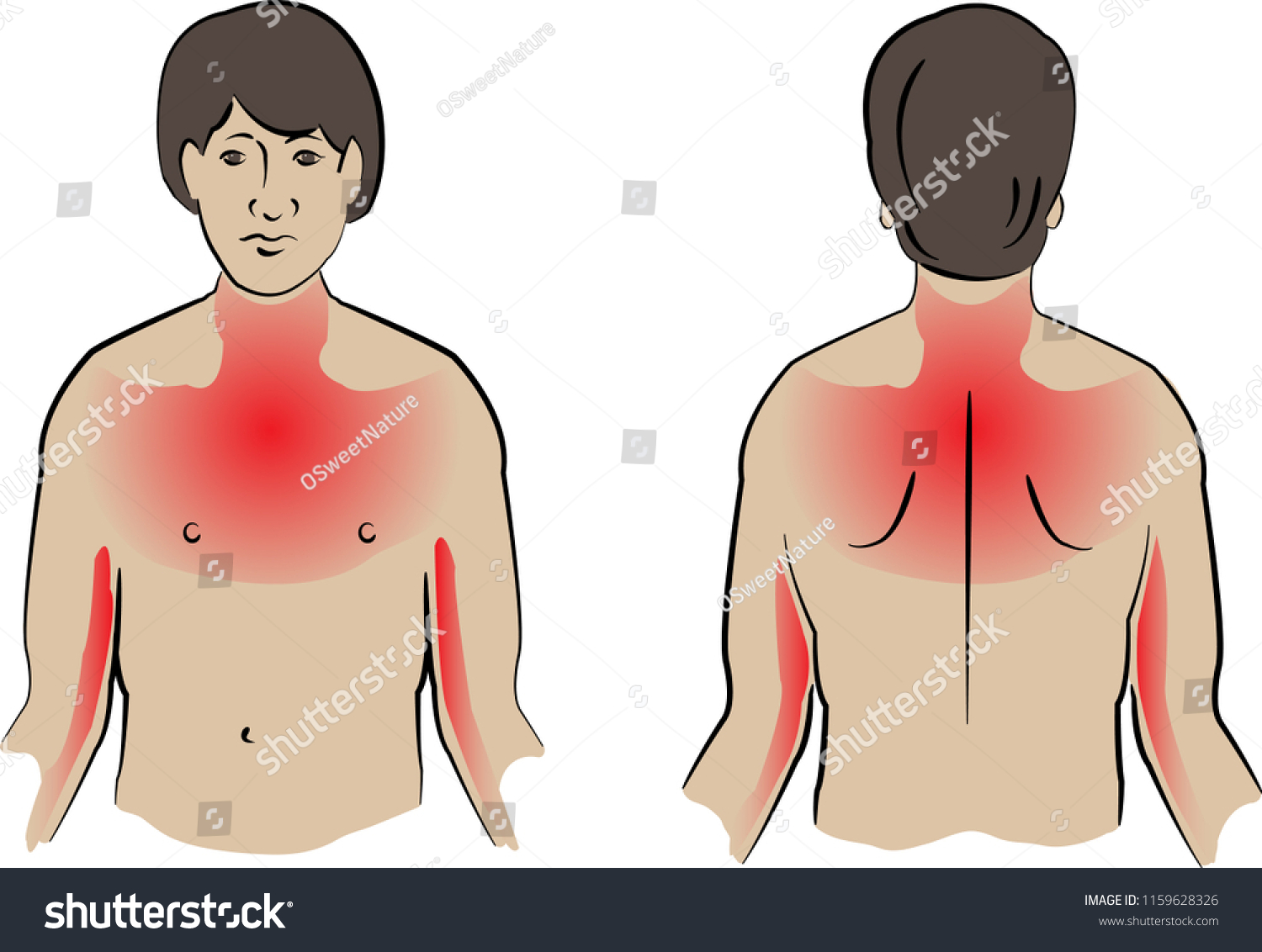 Heart Attack Pain Locations Anterior Posterior Stock Vector Royalty Free 1159628326