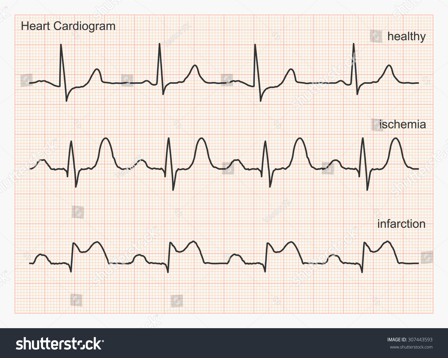 Heart Cardiogram Waves Three Types Cardiograms Stock Vector 307443593 ...