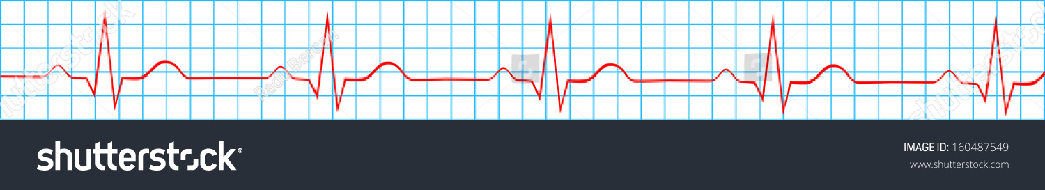 Heart Normal Sinus Rhythm On Electrocardiogram Stock Vector (Royalty ...