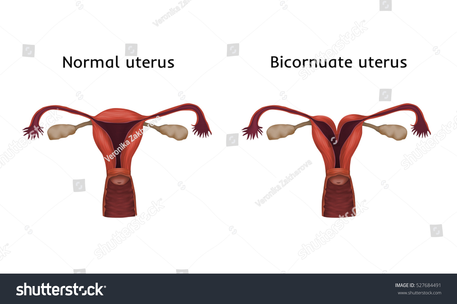 Heartshaped Becornuate Uterus Womb Uterine Abnormalities Stock Vector ...