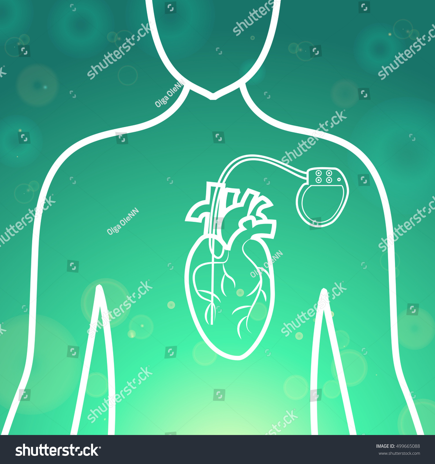 Heart Pacemaker Medical Wallpapervector Illustrationhuman Heart Vector