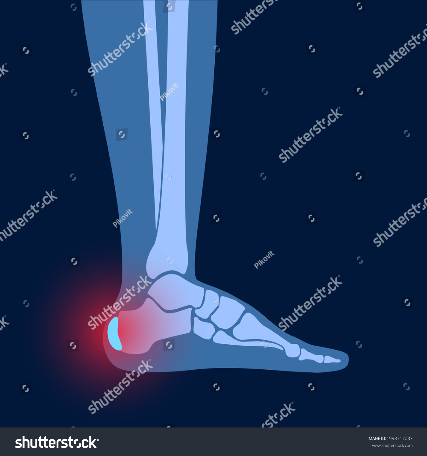 Heel Bursitis Inflammation Inflamed Bursa Human Stock Vector Royalty