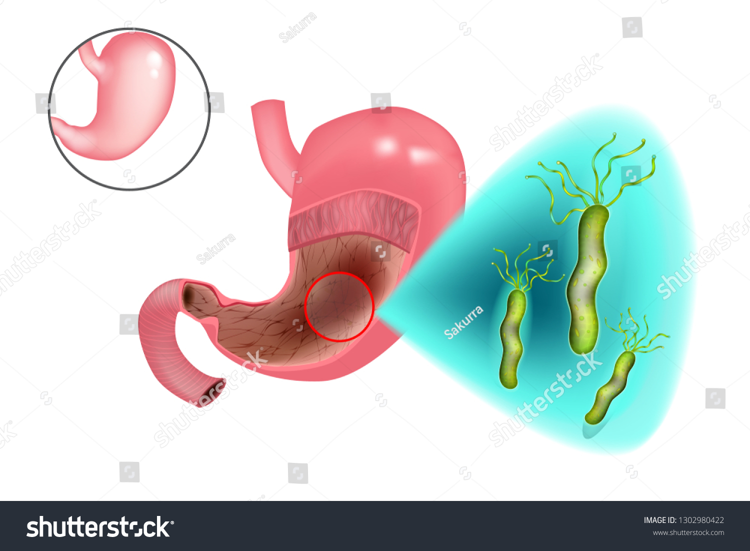 Vektor Stok Helicobacter Pylori Bacteria Campylobacter Pylori Human Tanpa Royalti