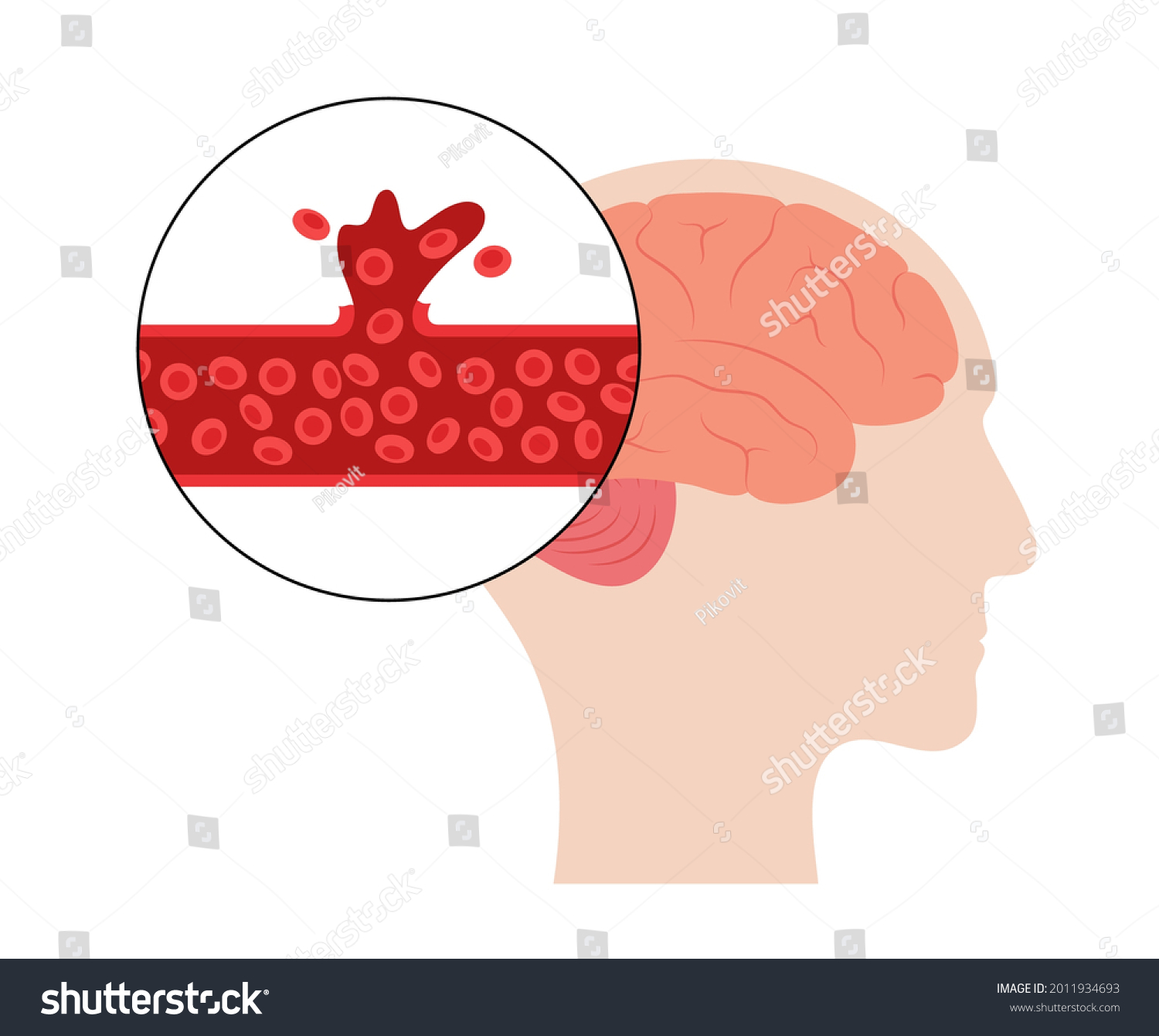 Hemorrhagic Brain Stroke Concept Apoplexy Cerebral Stock Vector Royalty Free 2011934693