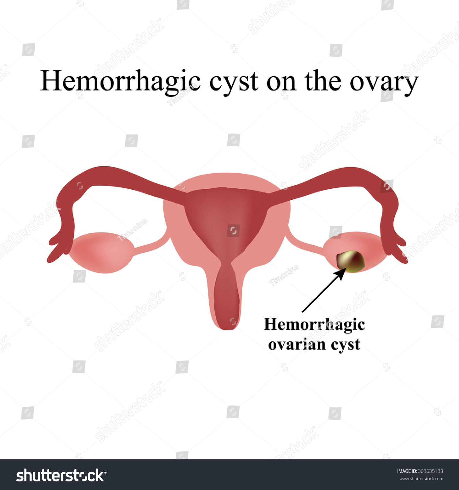 Hemorrhagic Cyst On Ovary Ovary Infographics Vector Có Sẵn Miễn Phí